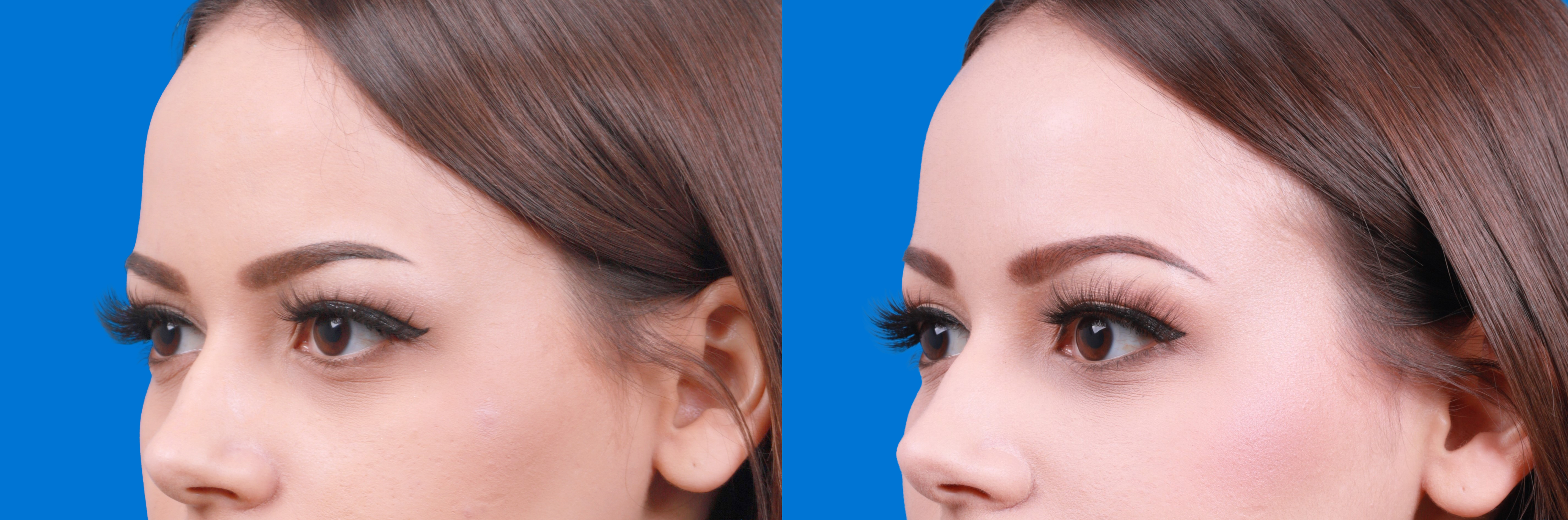 Dermal Fillers Before & After Gallery - Patient 122610219 - Image 3