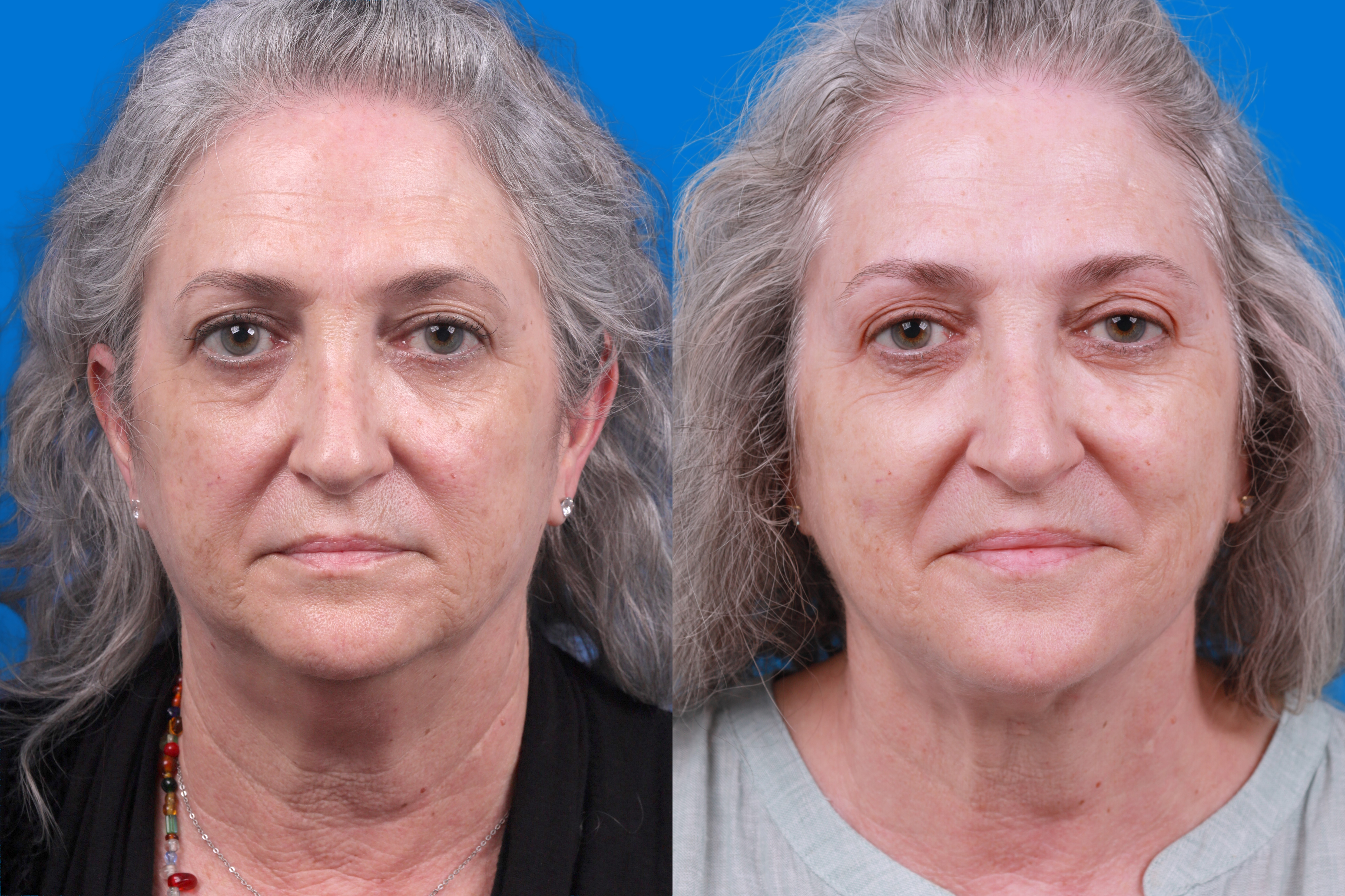Express Lift Before & After Gallery - Patient 122592010 - Image 1