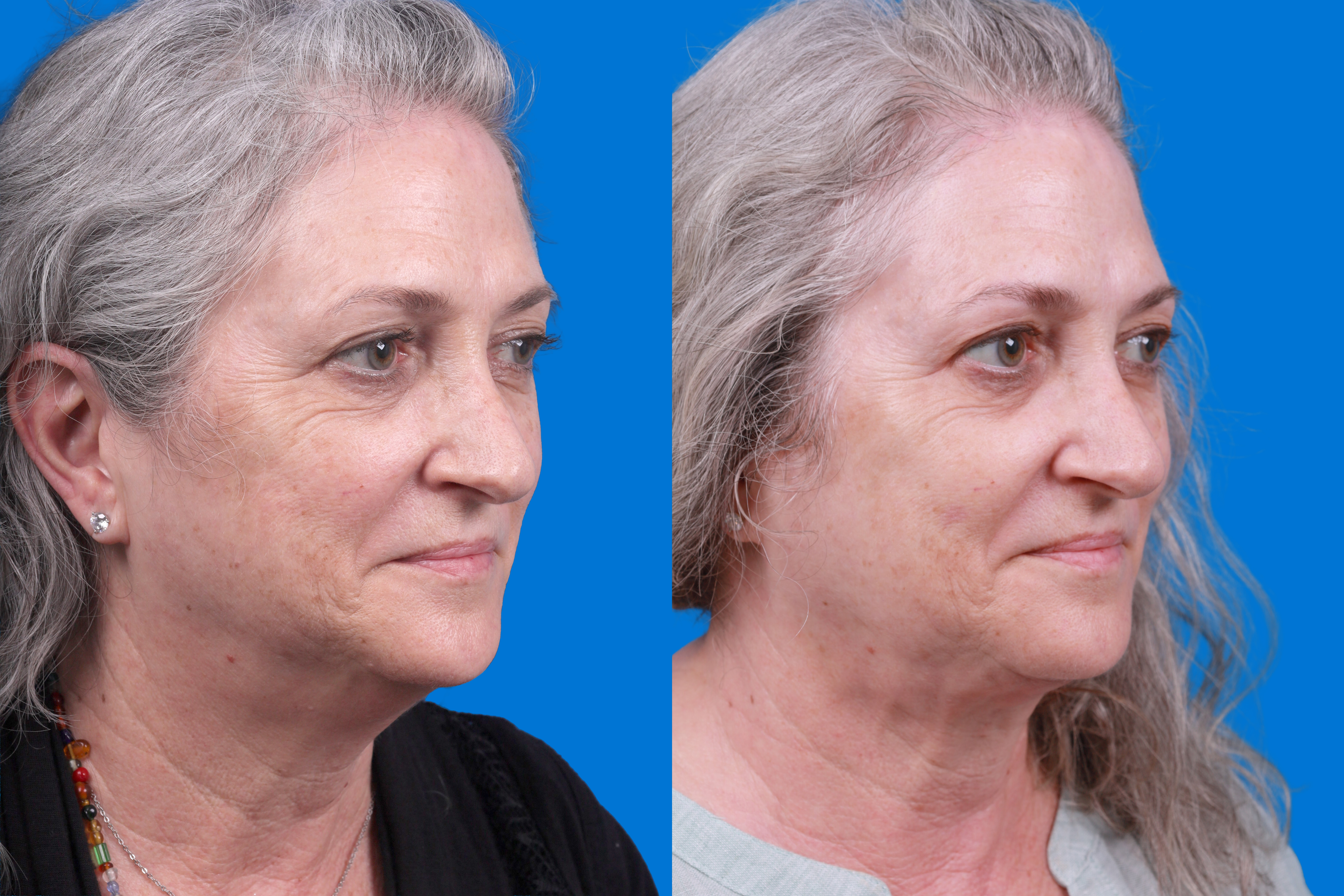 Express Lift Before & After Gallery - Patient 122592010 - Image 2