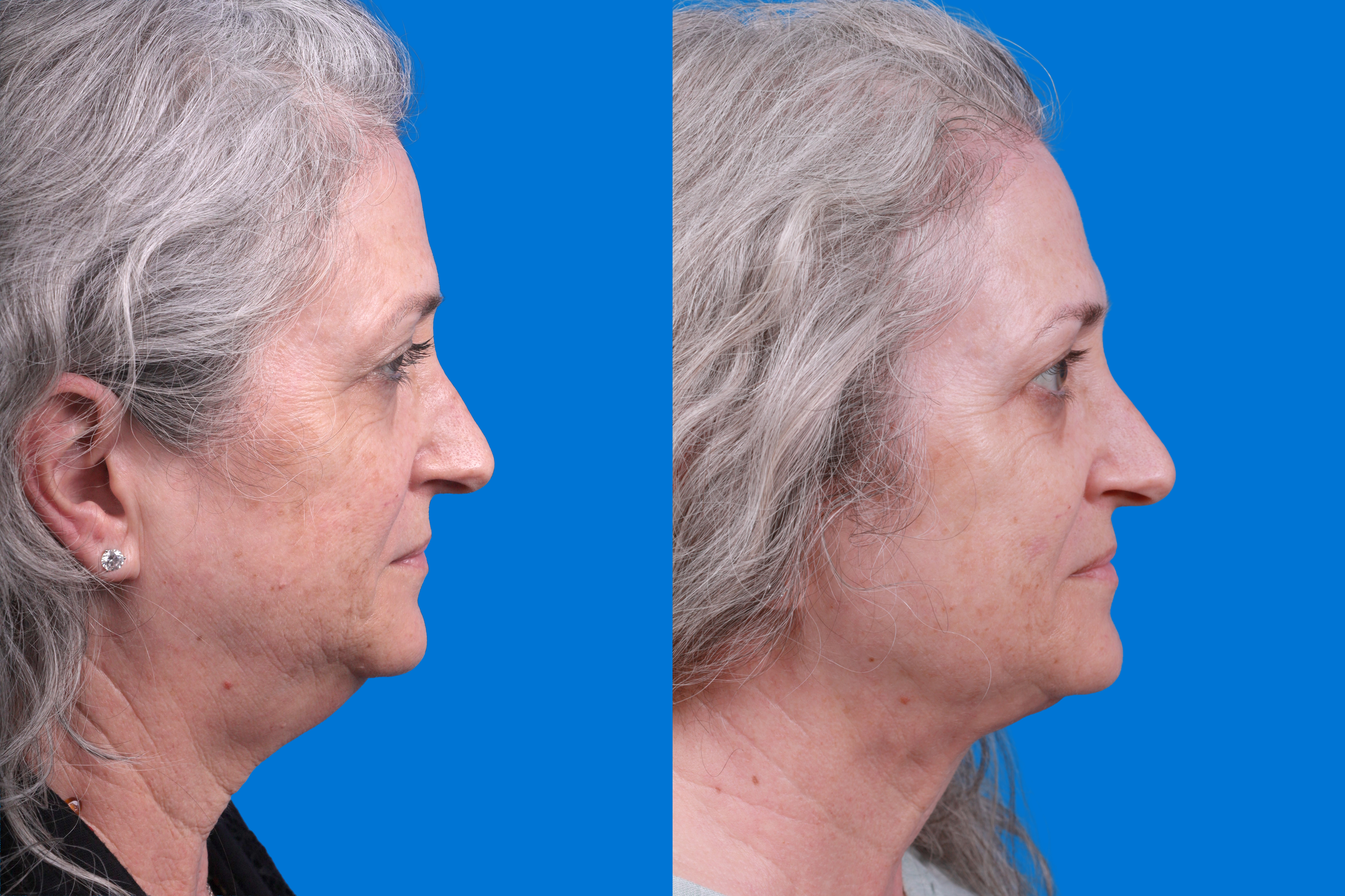 Express Lift Before & After Gallery - Patient 122592010 - Image 3