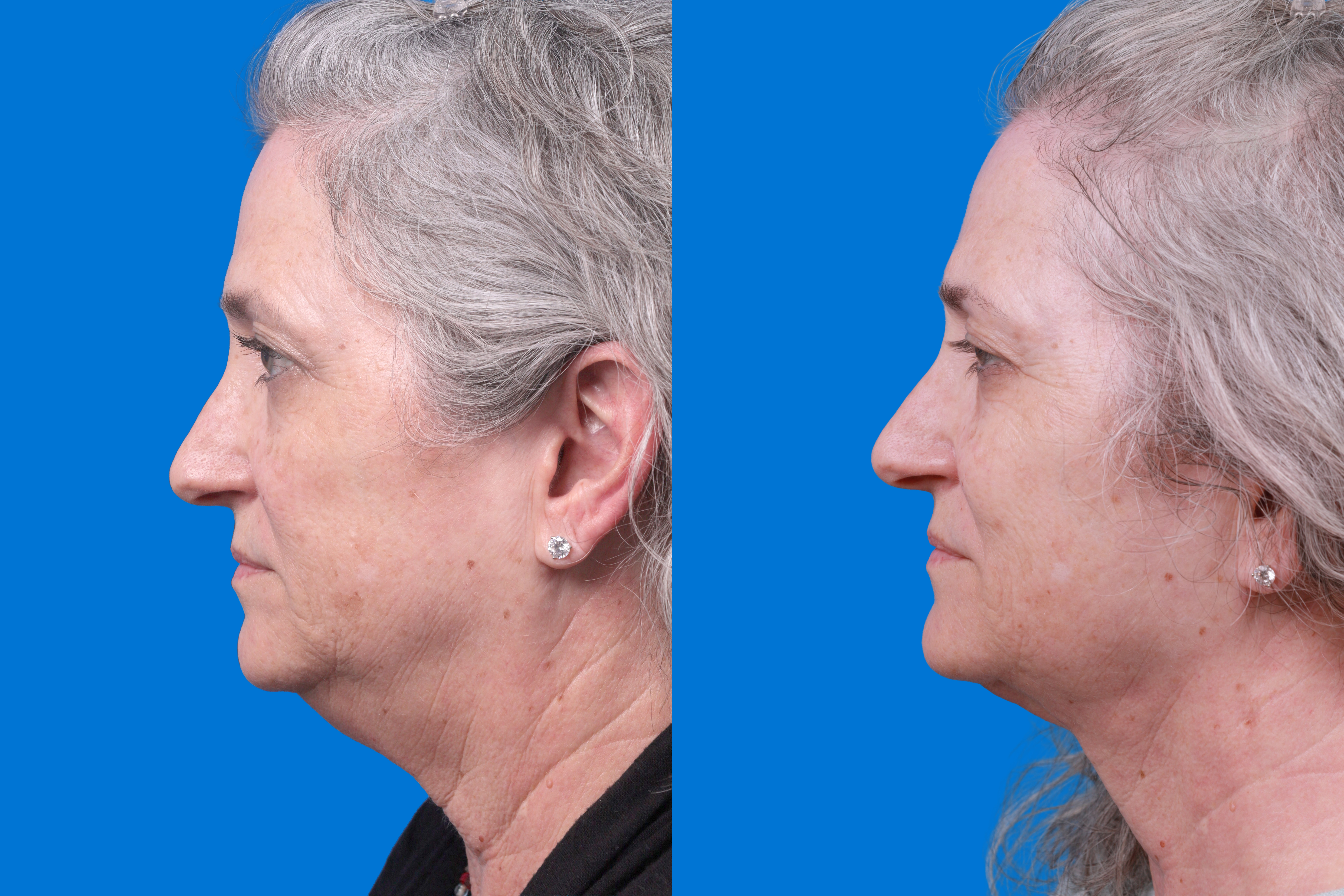 Express Lift Before & After Gallery - Patient 122592010 - Image 5