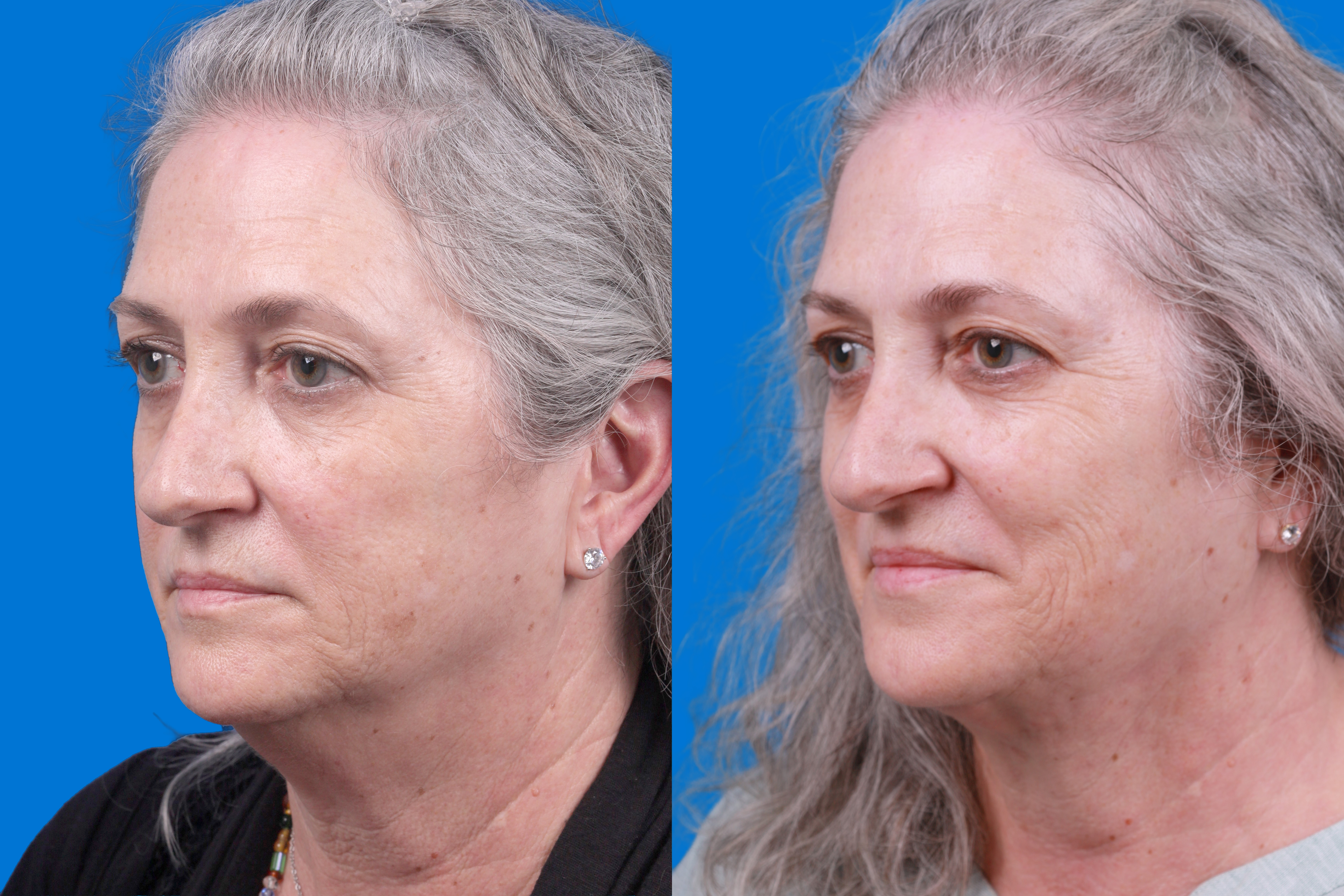 Express Lift Before & After Gallery - Patient 122592010 - Image 4