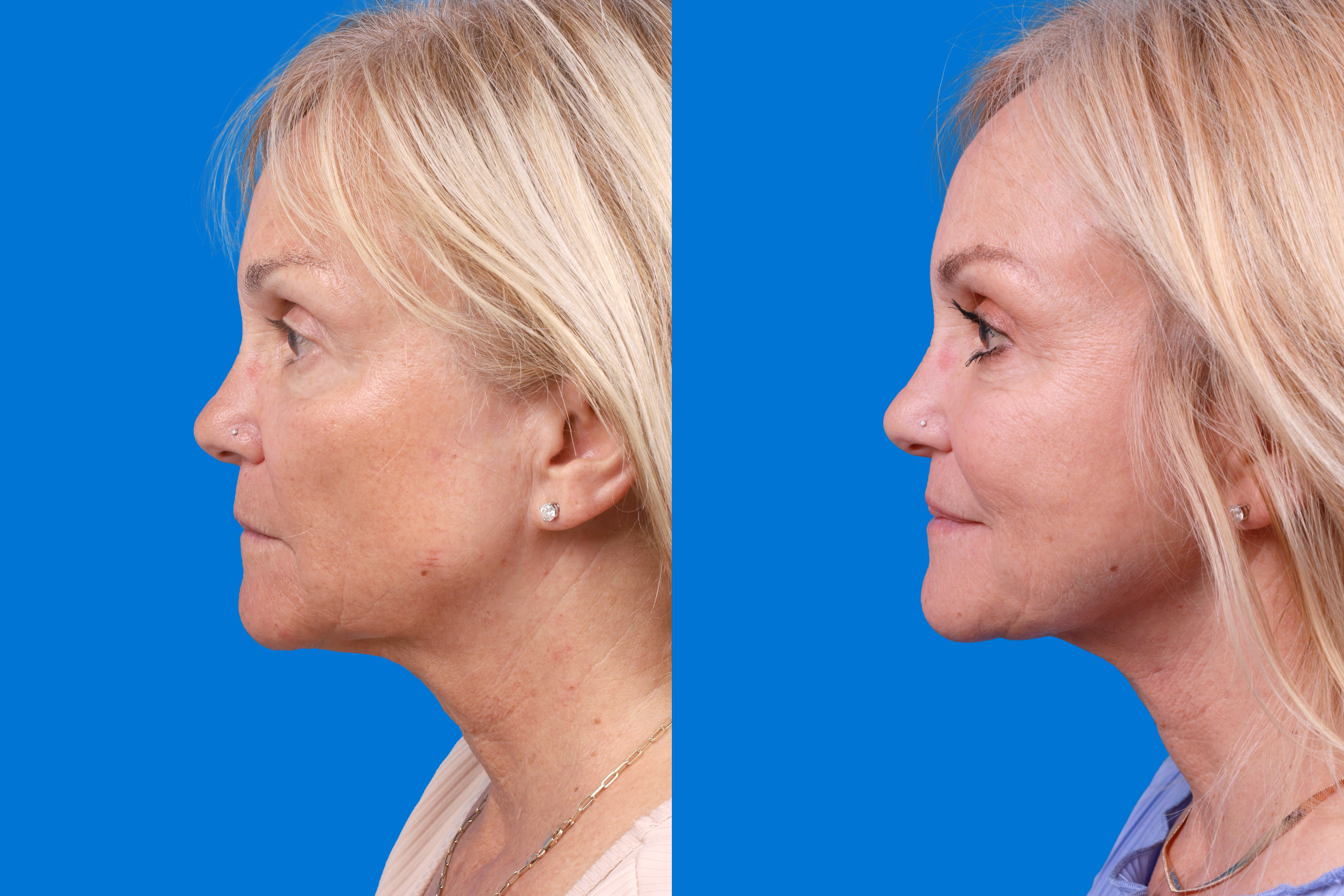 Express Lift Before & After Gallery - Patient 370023 - Image 5