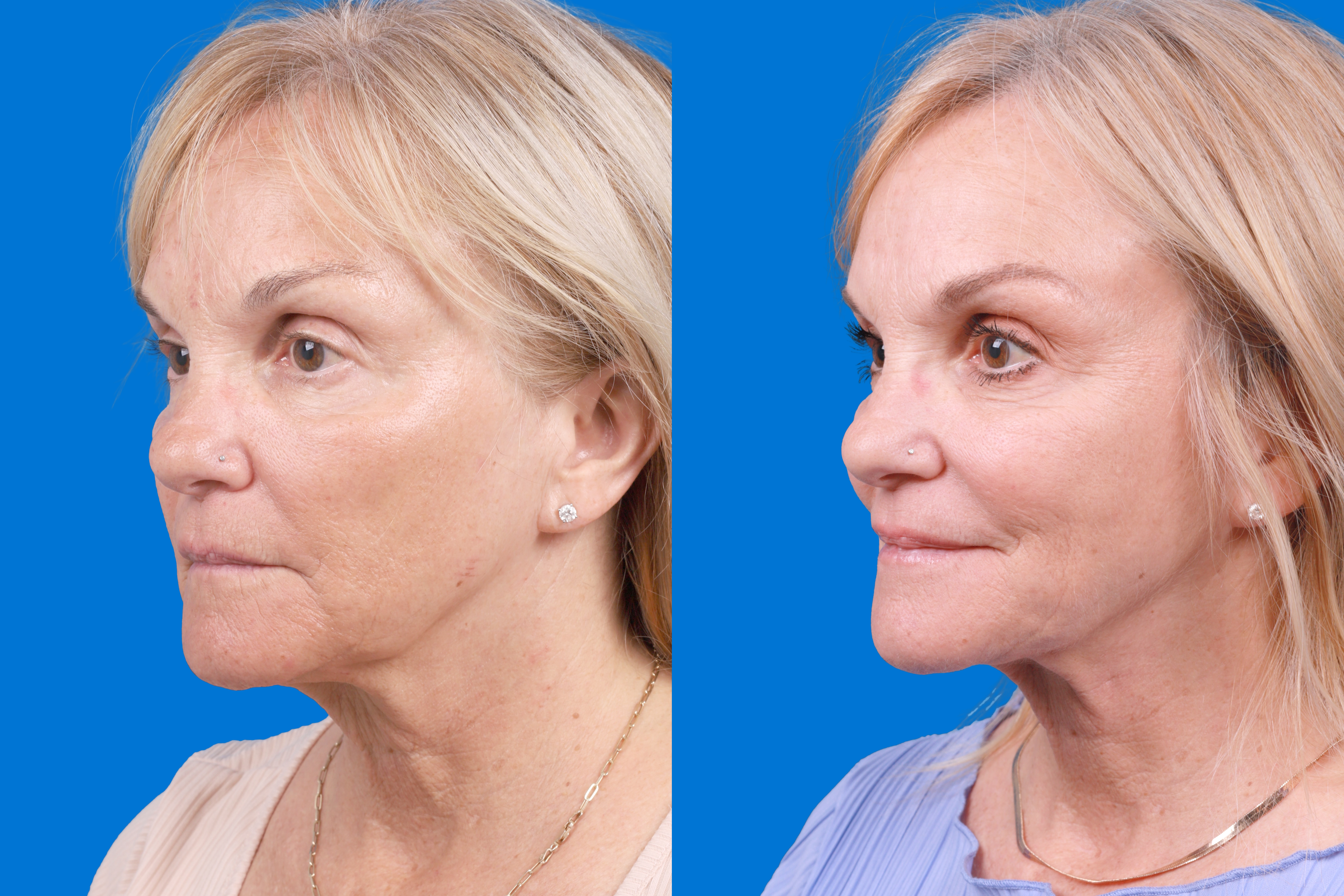 Express Lift Before & After Gallery - Patient 370023 - Image 4