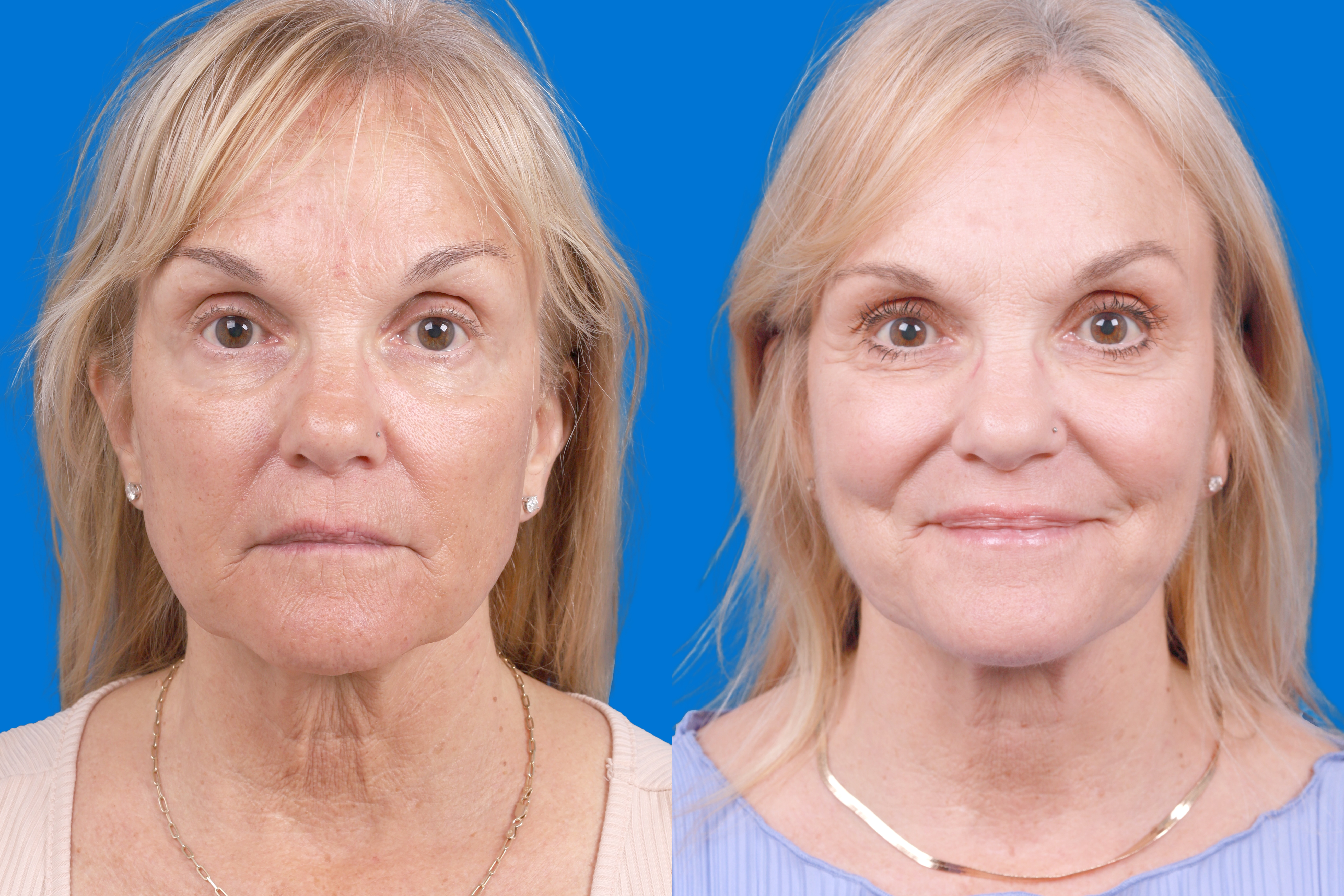 Express Lift Before & After Gallery - Patient 370023 - Image 1