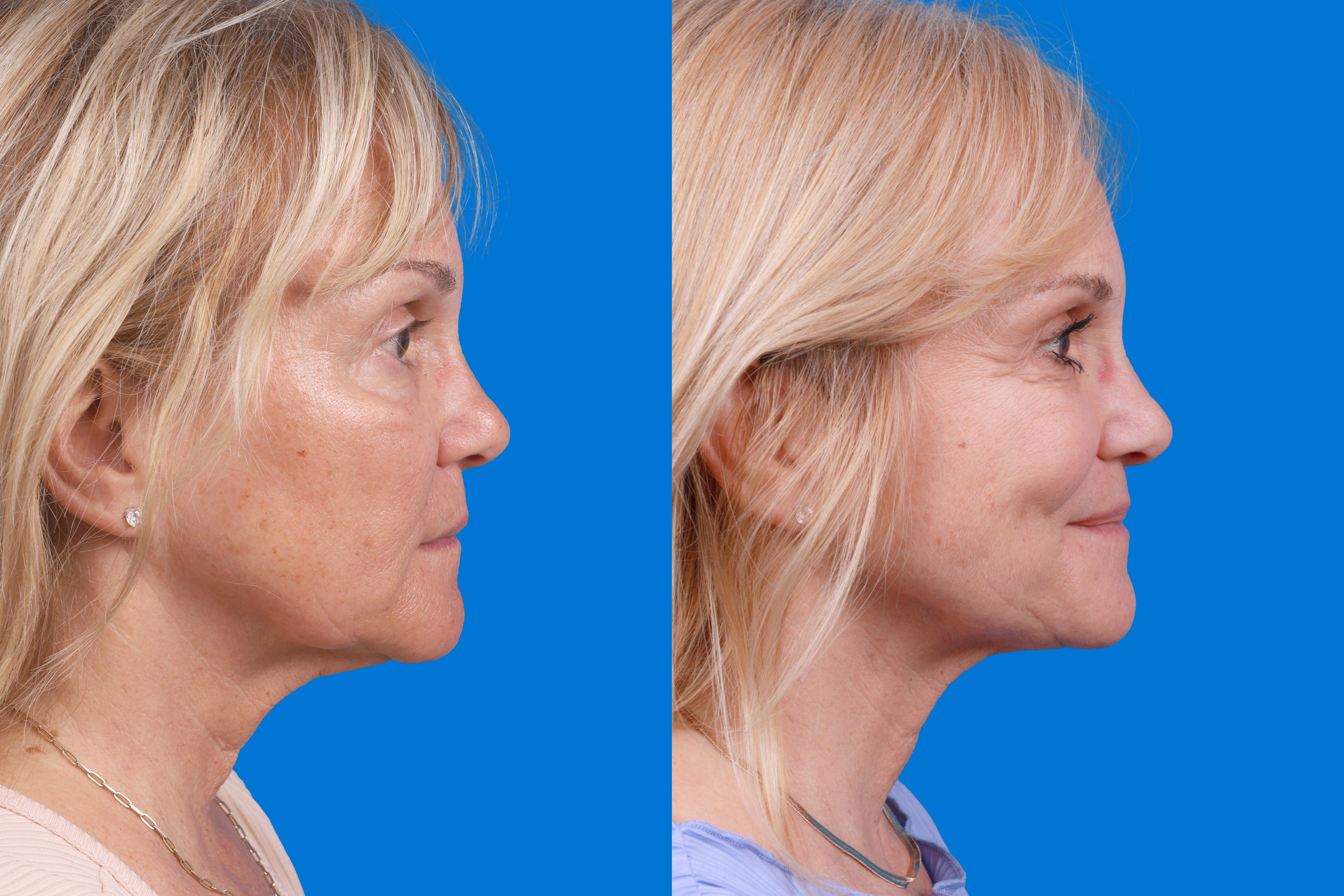 Express Lift Before & After Gallery - Patient 370023 - Image 3