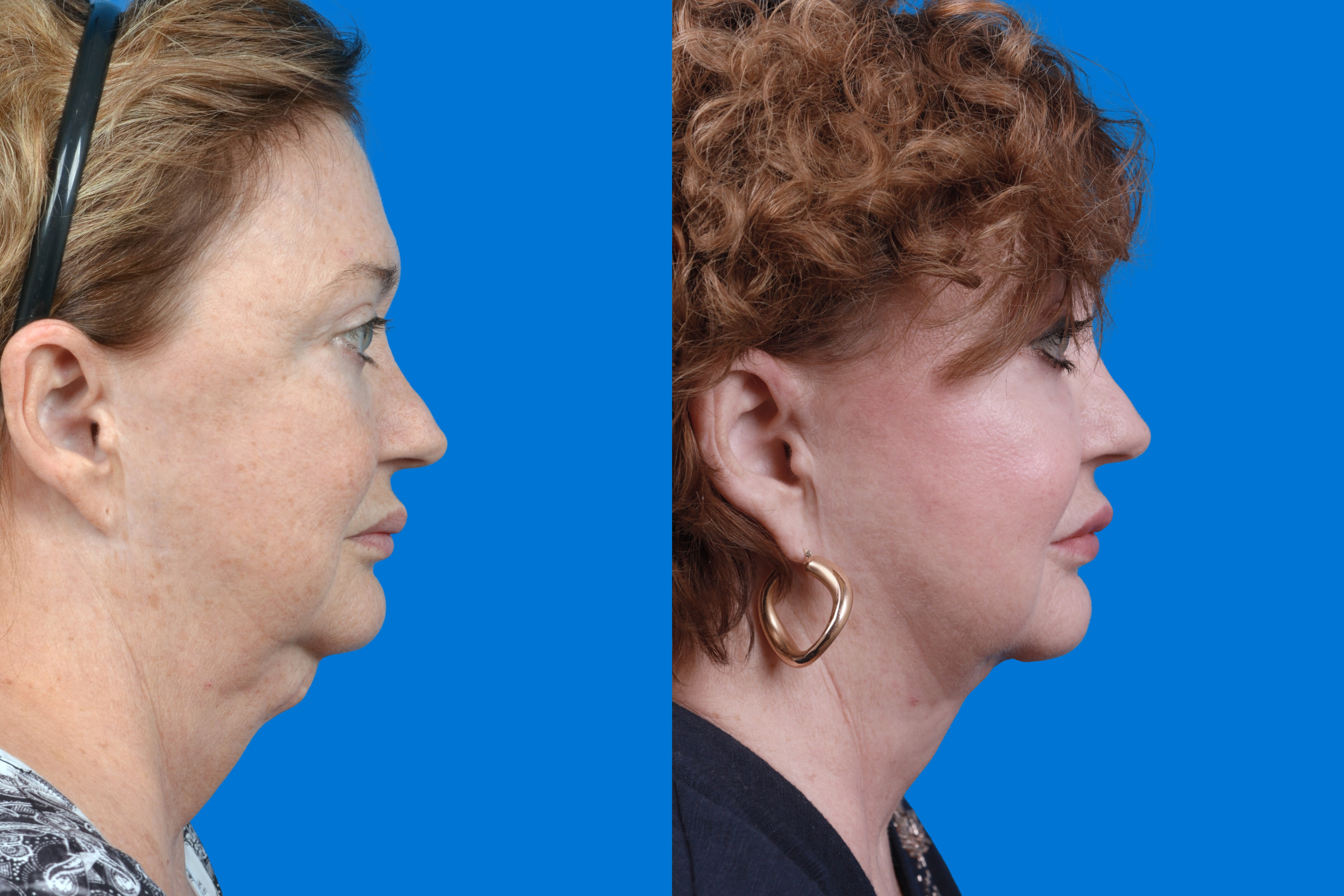 Profile Neck Lift Before & After Gallery - Patient 122594278 - Image 5