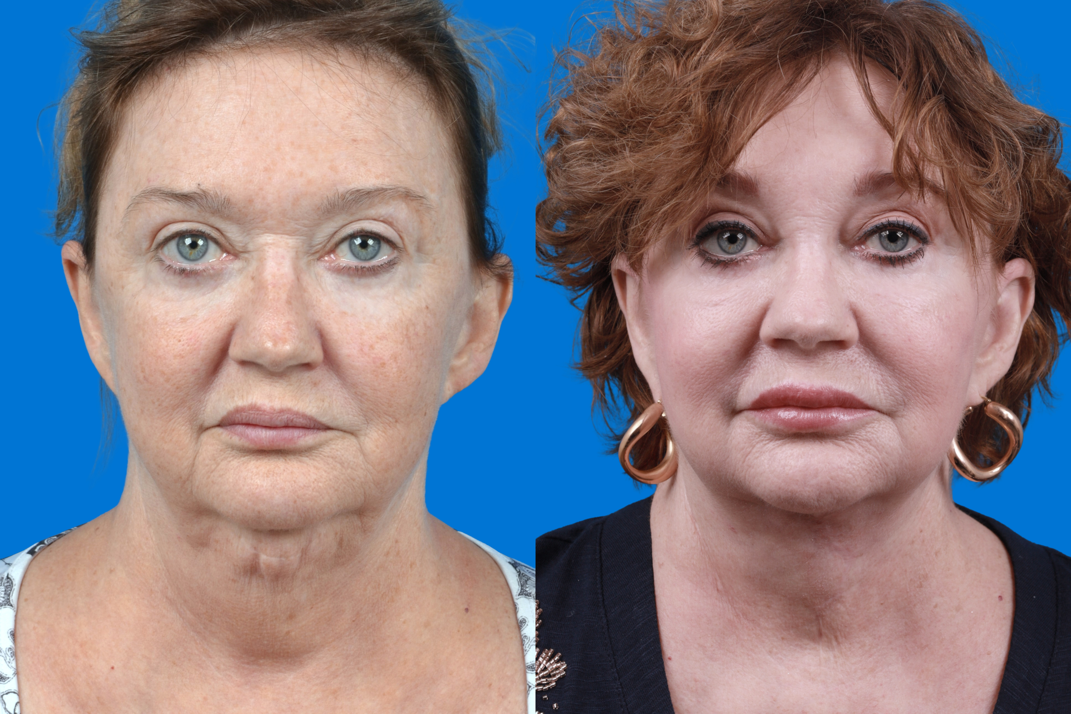 Profile Neck Lift Before & After Gallery - Patient 122594278 - Image 3