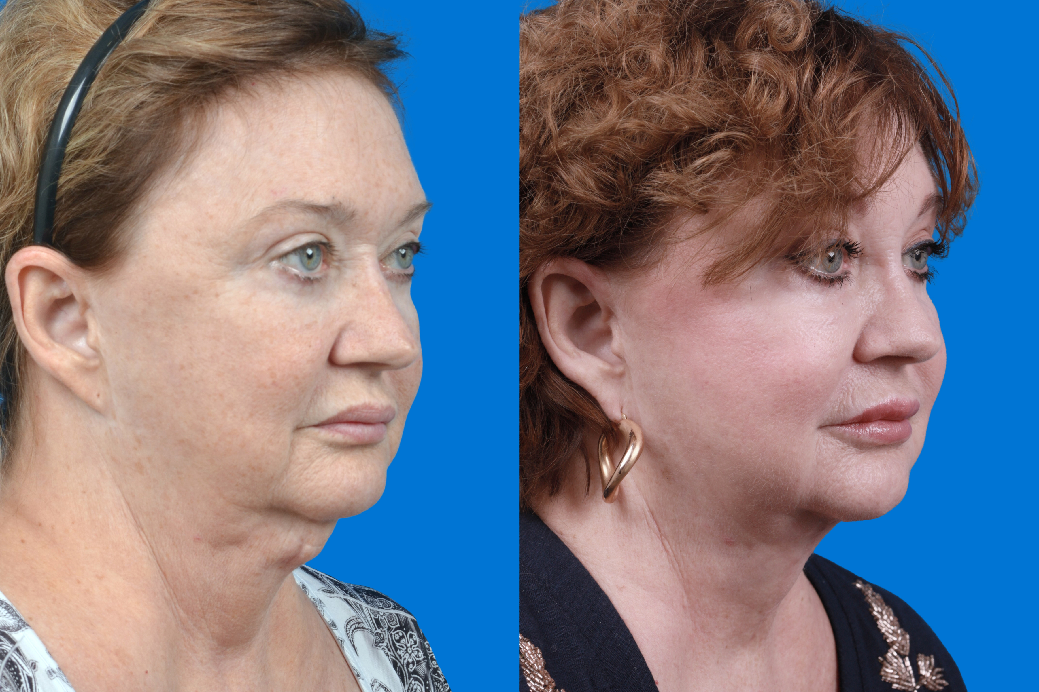 Profile Neck Lift Before & After Gallery - Patient 122594278 - Image 4