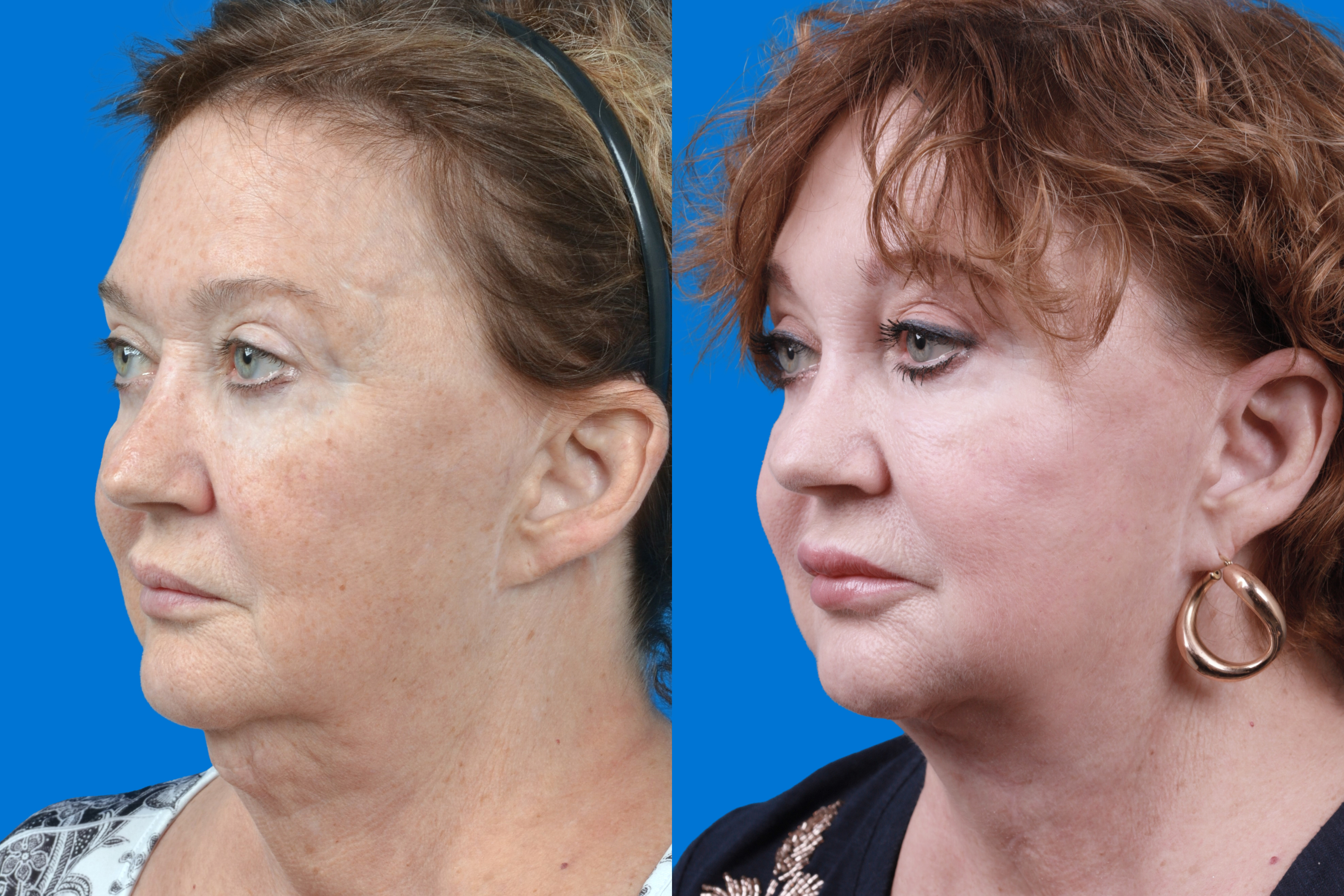 Profile Neck Lift Before & After Gallery - Patient 122594278 - Image 2