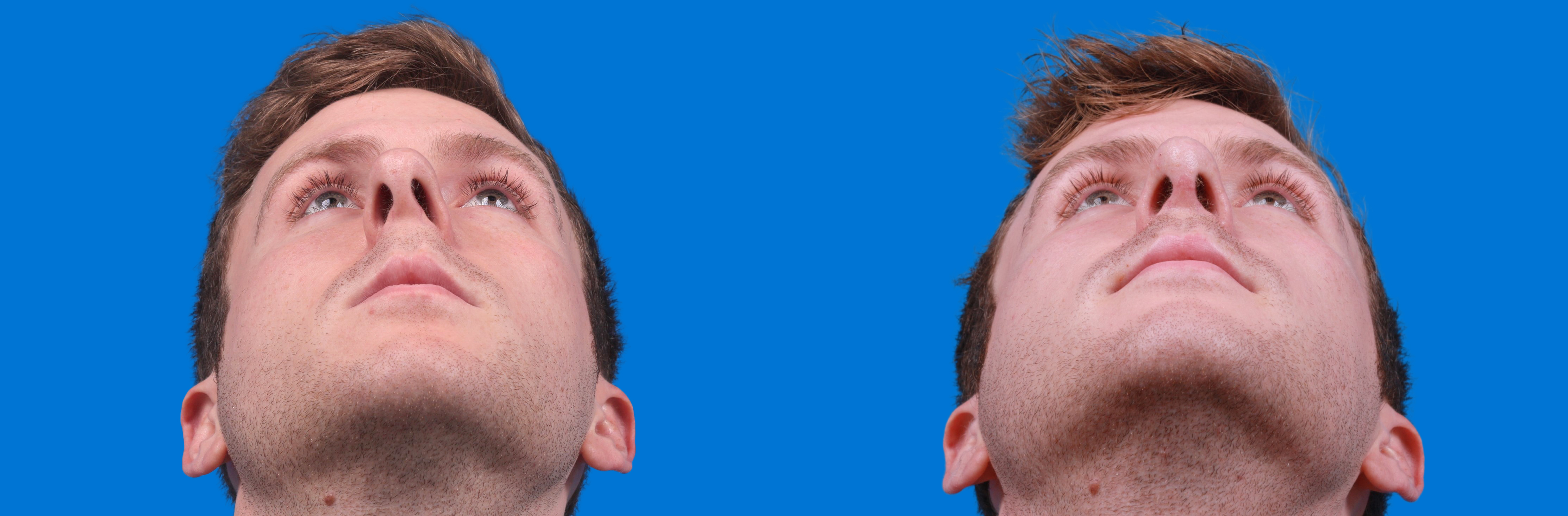 Rhinoplasty Before & After Gallery - Patient 122594280 - Image 2