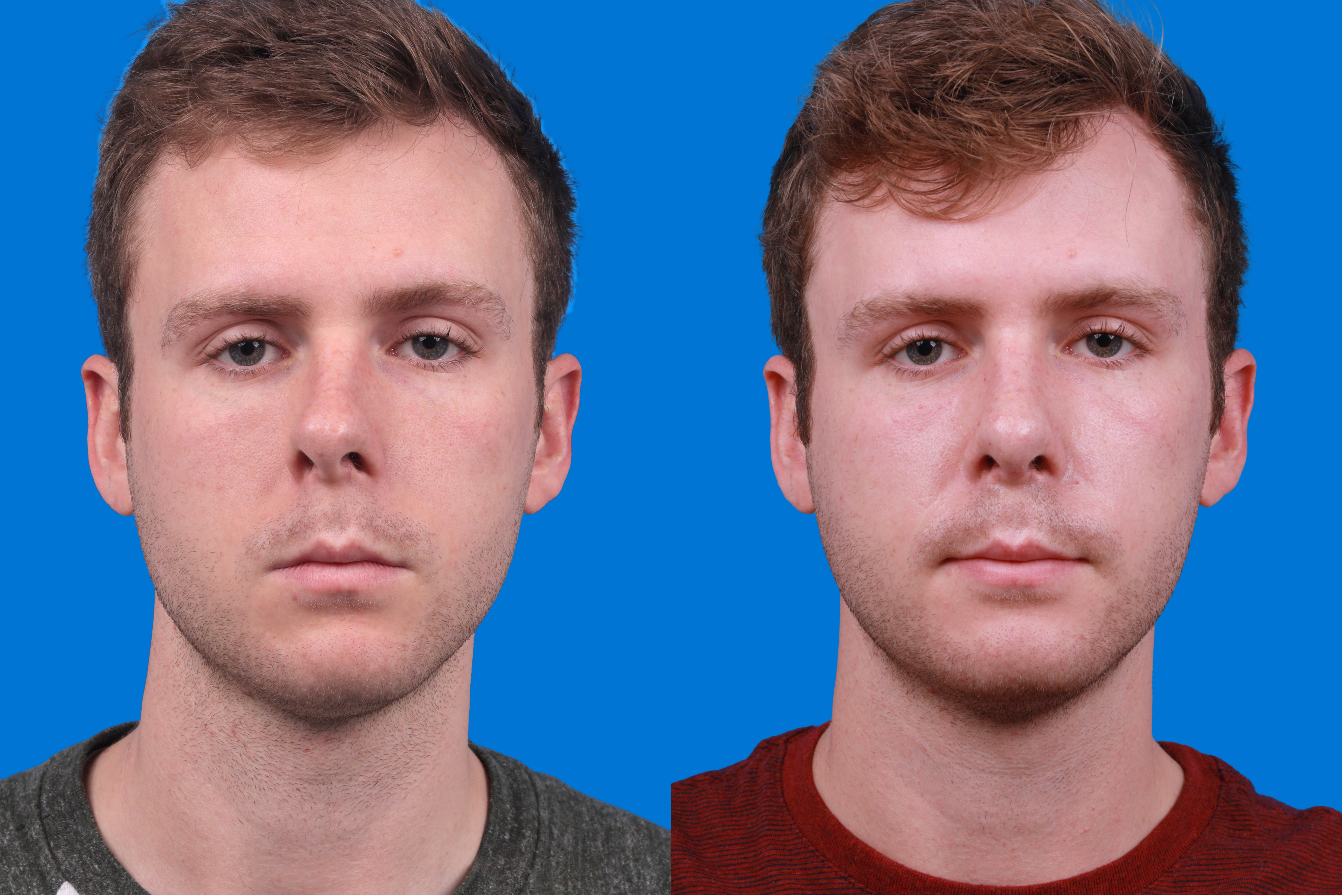 Rhinoplasty Before & After Gallery - Patient 122594280 - Image 1