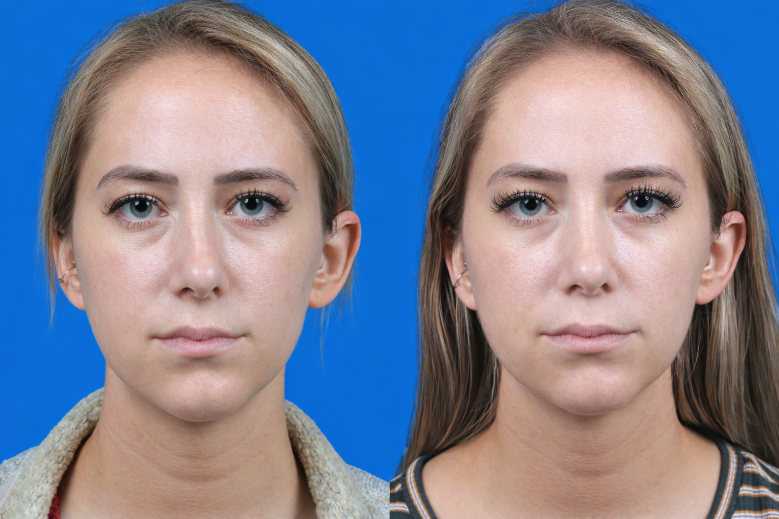 Rhinoplasty Before & After Gallery - Patient 122593917 - Image 3