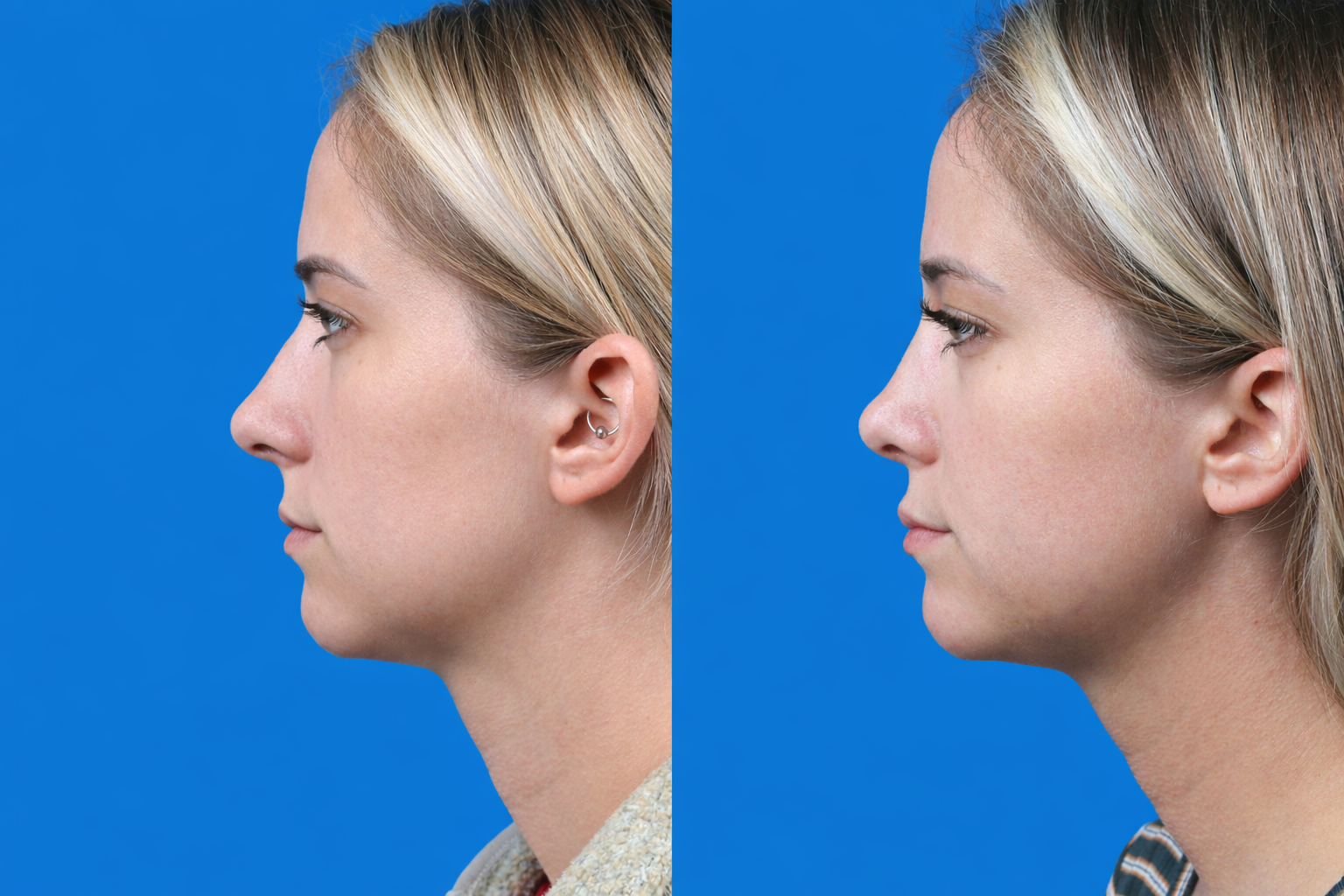 Rhinoplasty Before & After Gallery - Patient 122593917 - Image 1