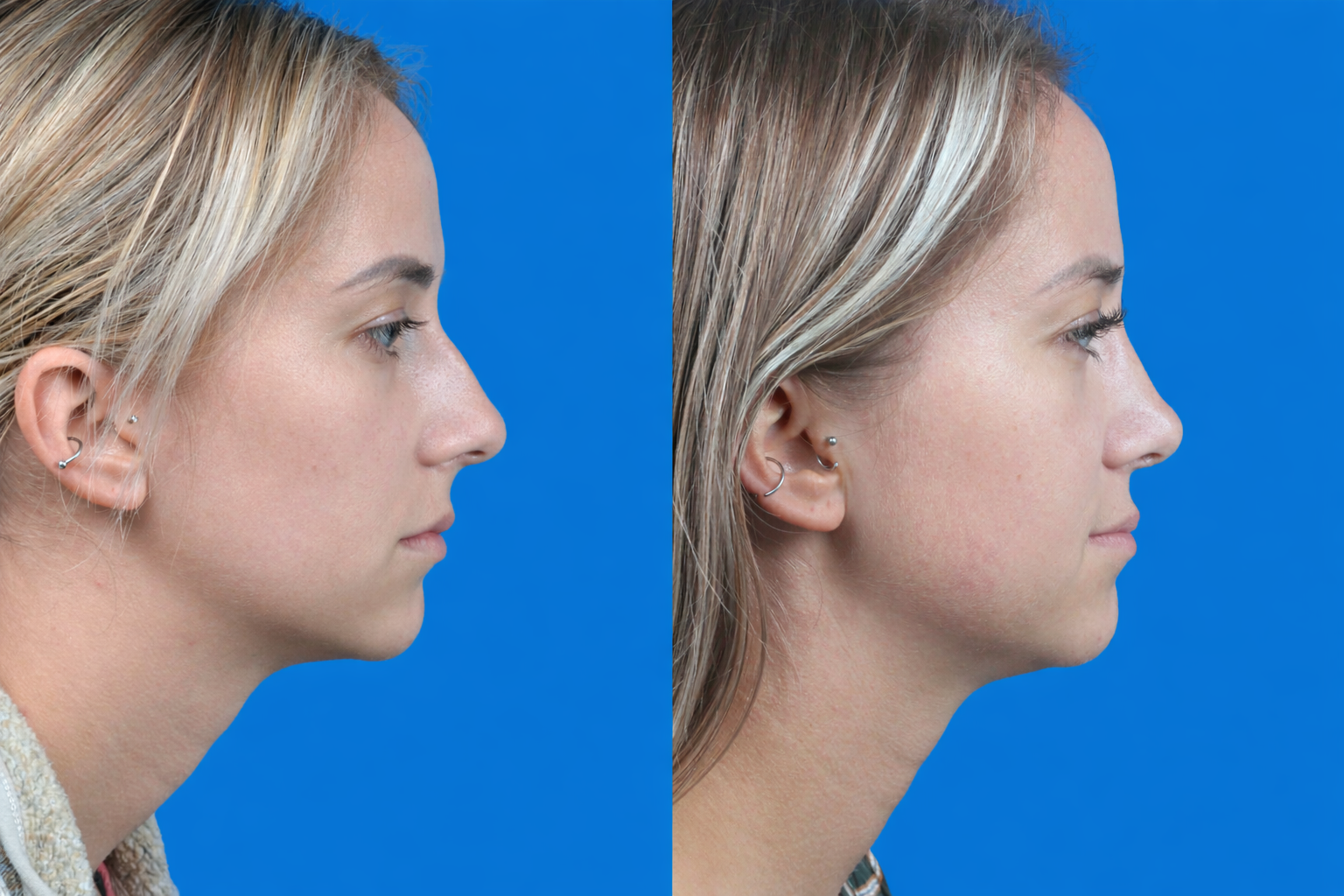 Rhinoplasty Before & After Gallery - Patient 122593917 - Image 5