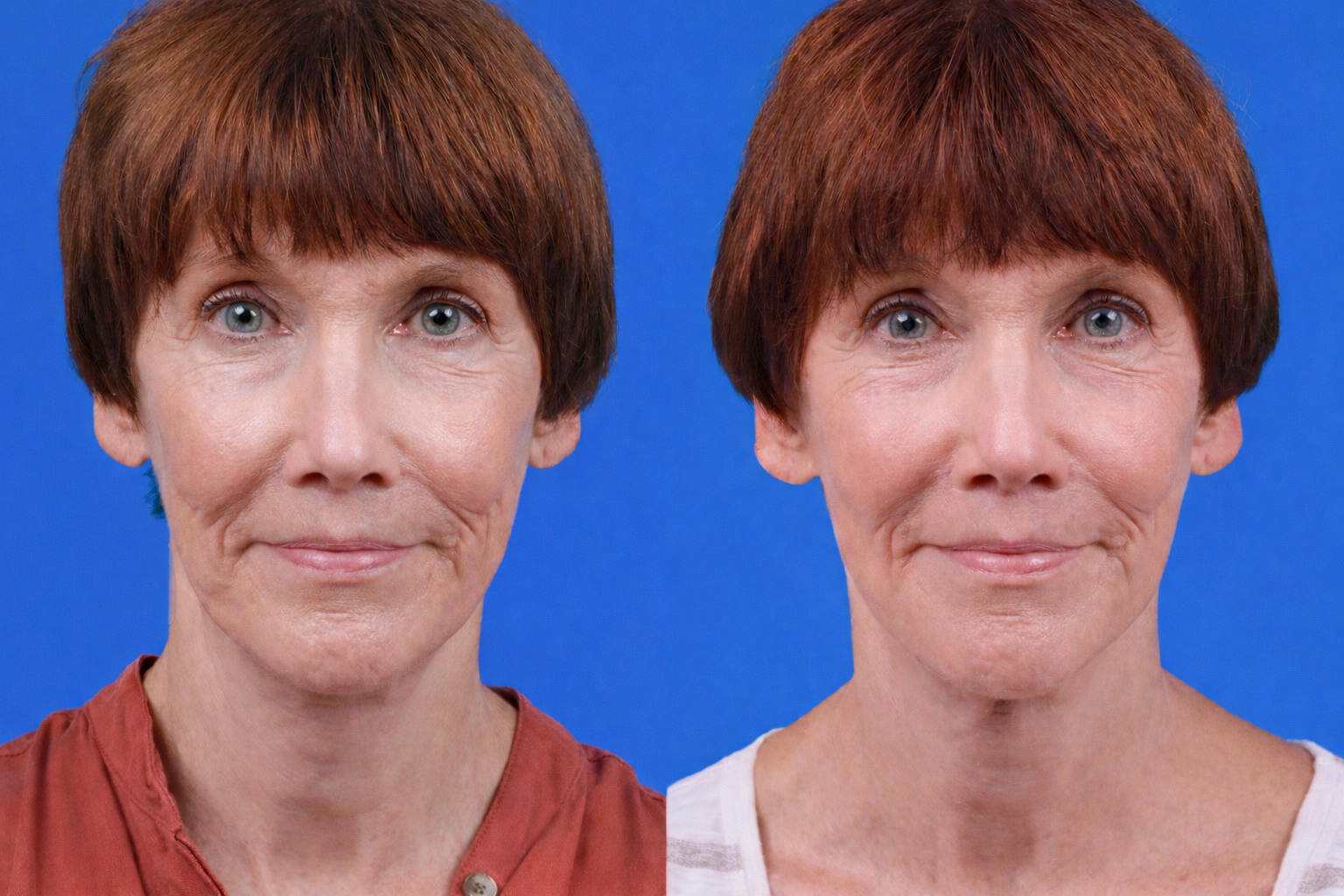 Express Lift Before & After Gallery - Patient 122591995 - Image 3