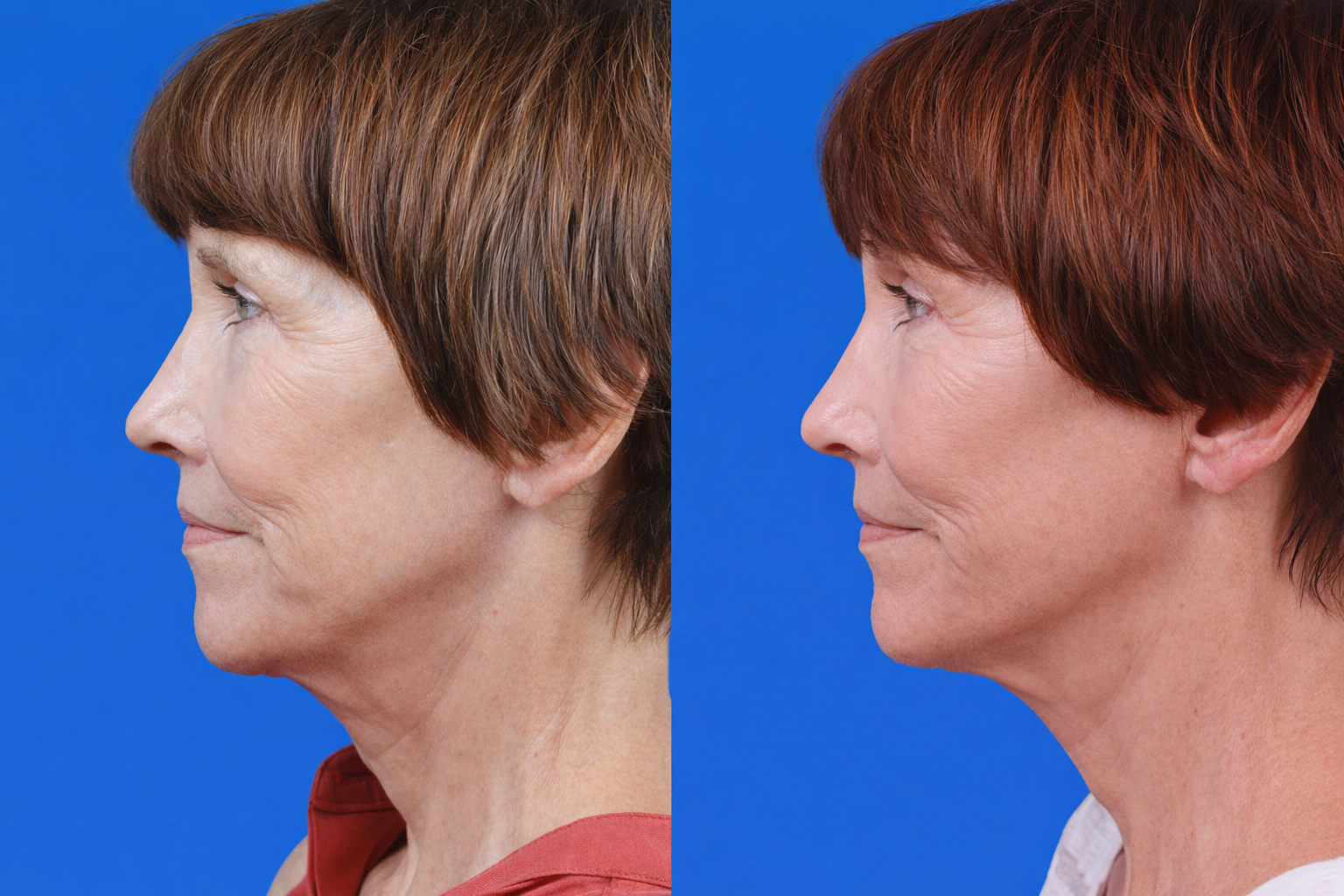 Express Lift Before & After Gallery - Patient 122591995 - Image 1