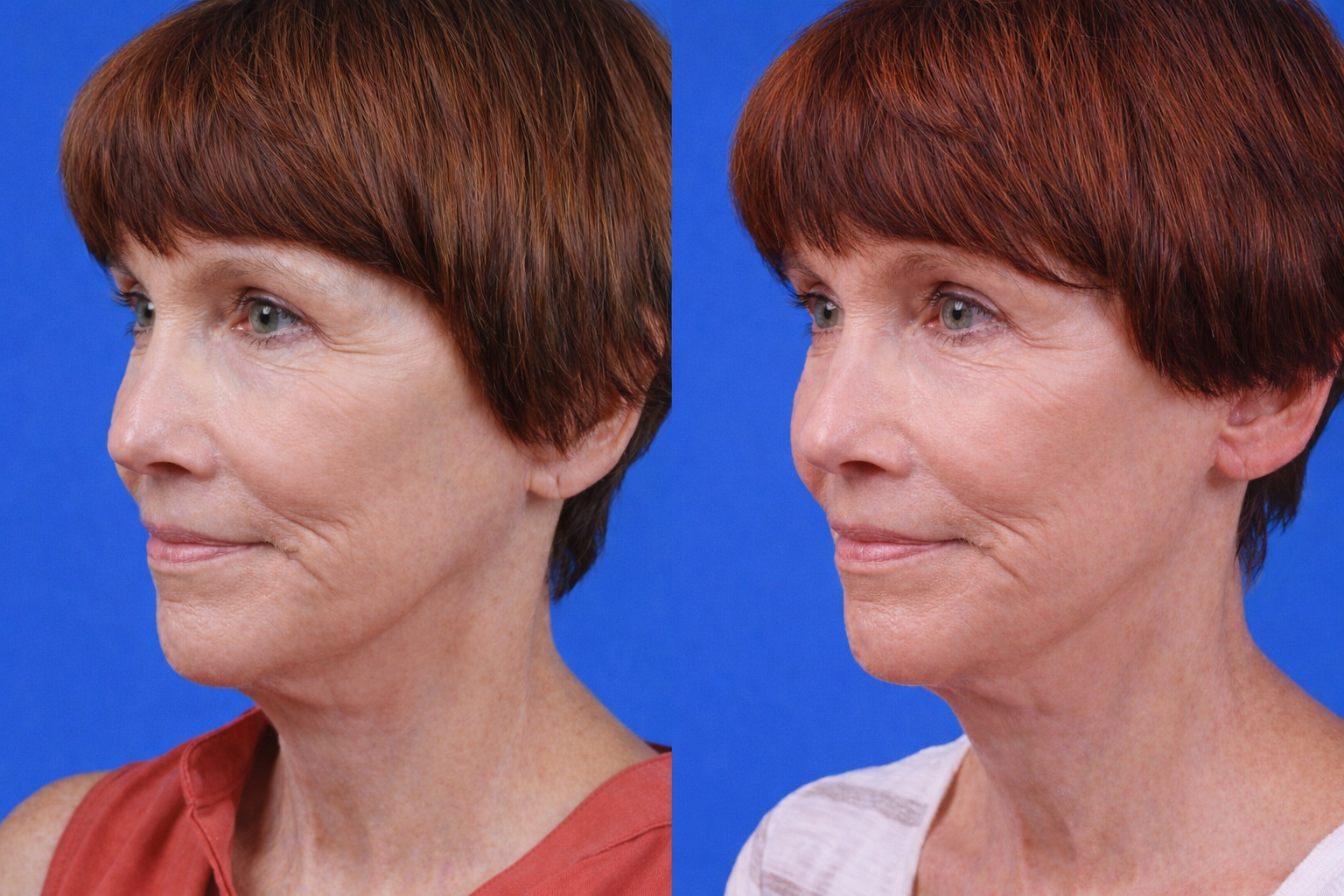 Express Lift Before & After Gallery - Patient 122591995 - Image 2