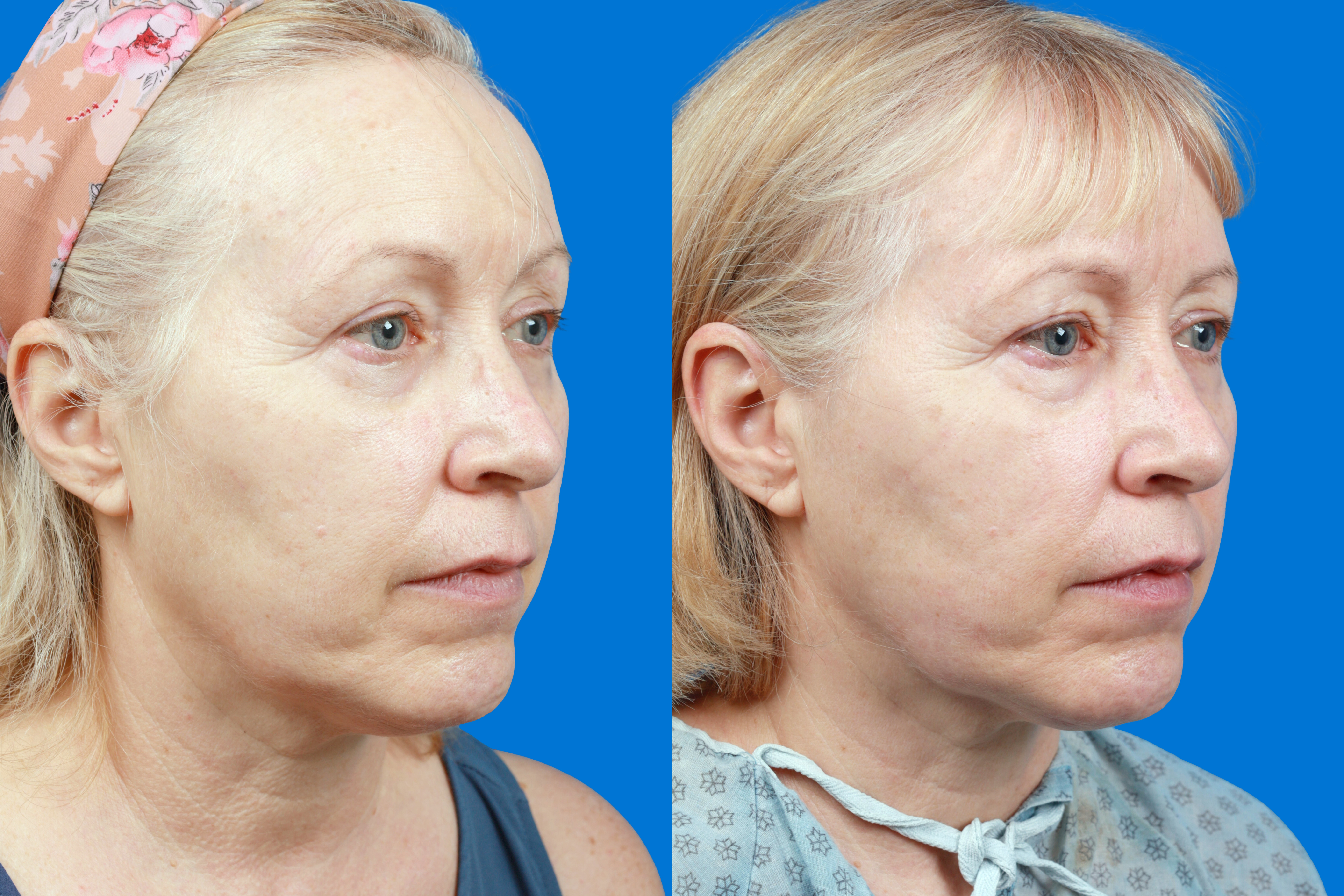 Express Lift Before & After Gallery - Patient 122591994 - Image 3