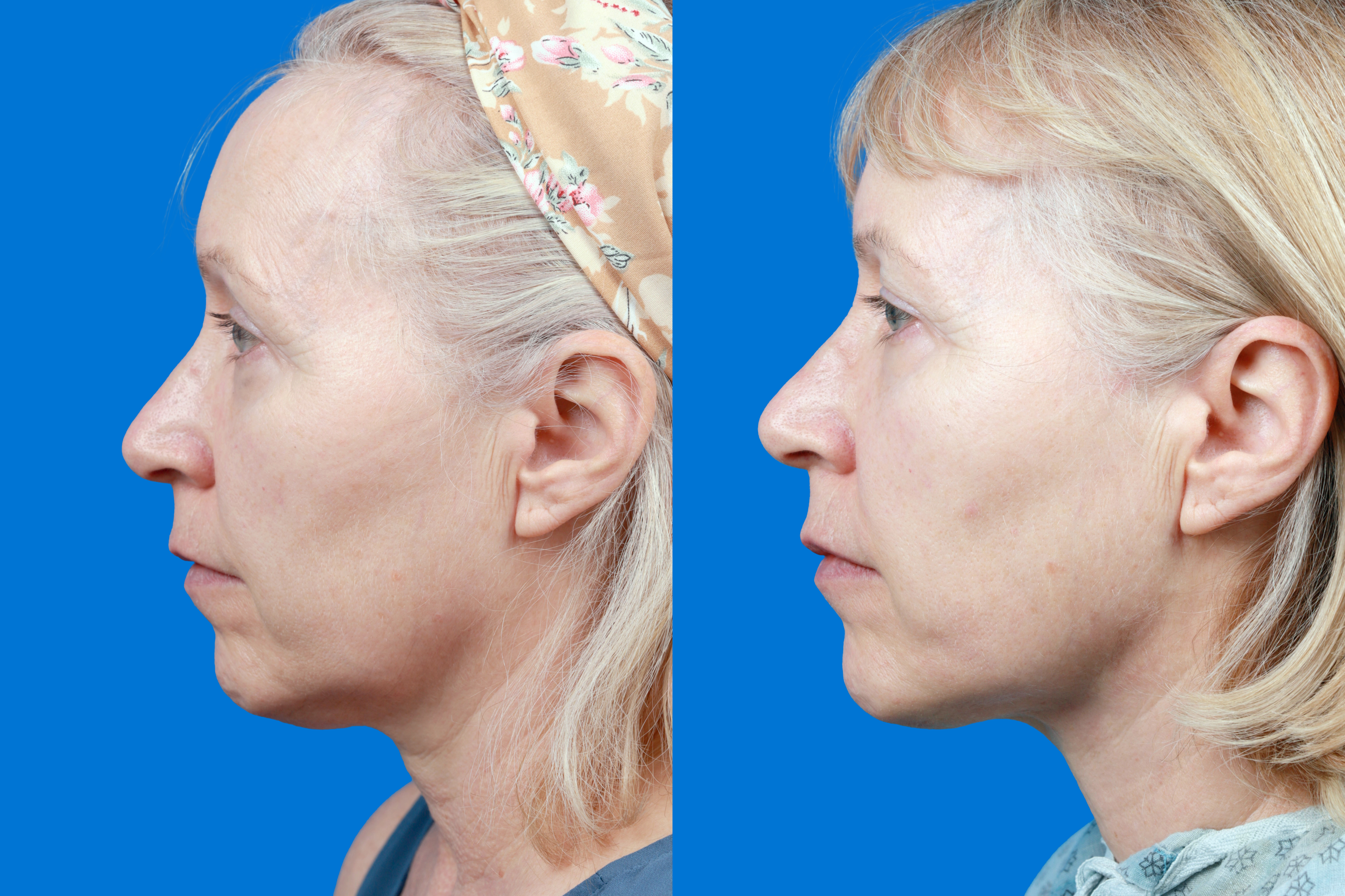 Express Lift Before & After Gallery - Patient 122591994 - Image 5