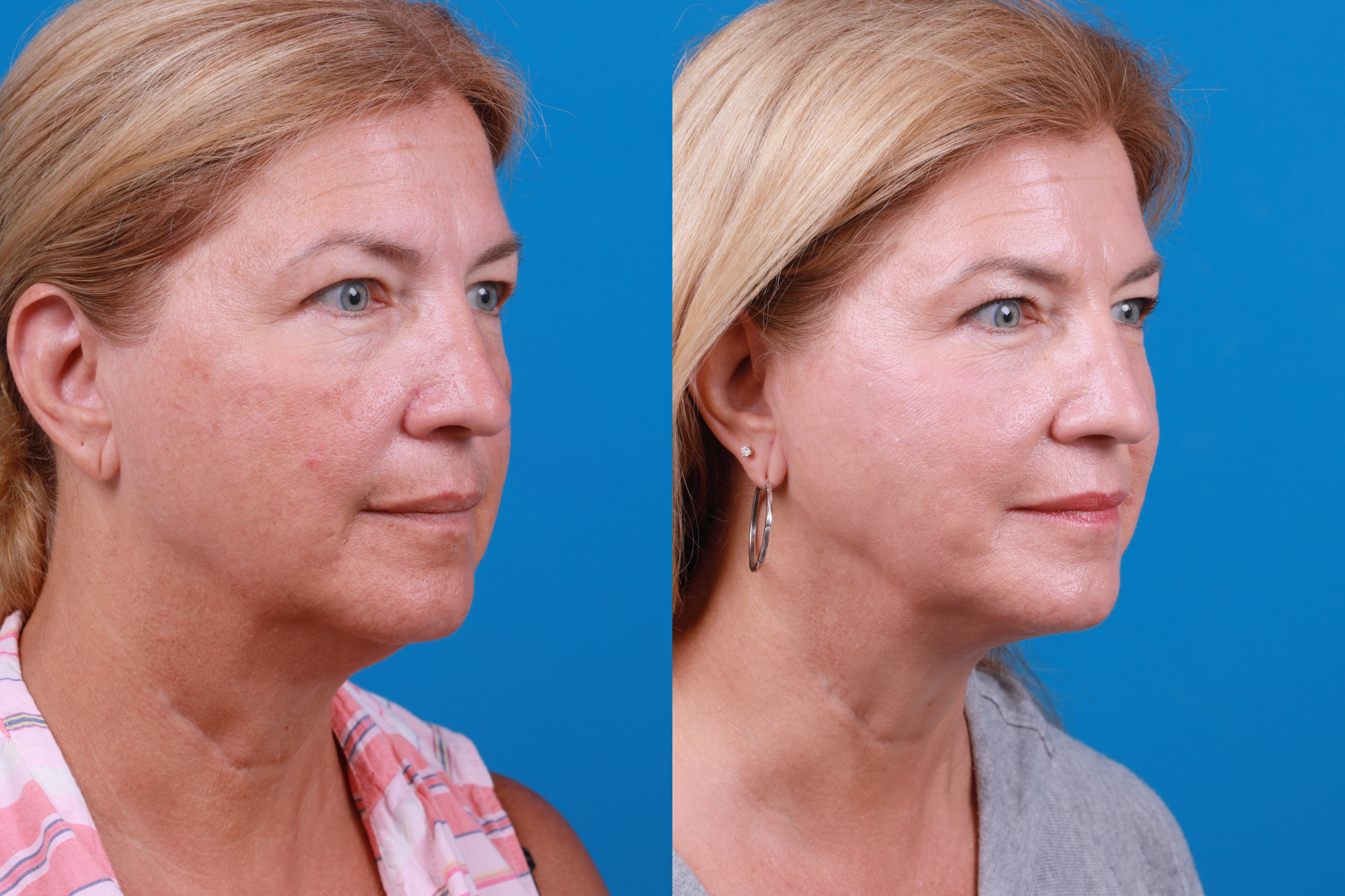 Morpheus8 Before & After Gallery - Patient 916915 - Image 5