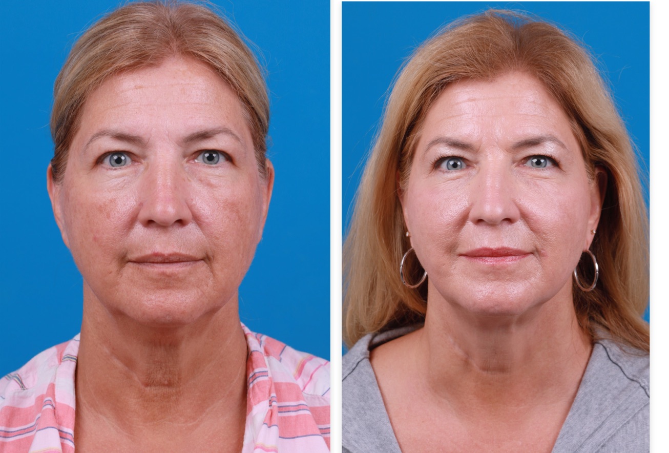 Morpheus8 Before & After Gallery - Patient 916915 - Image 1
