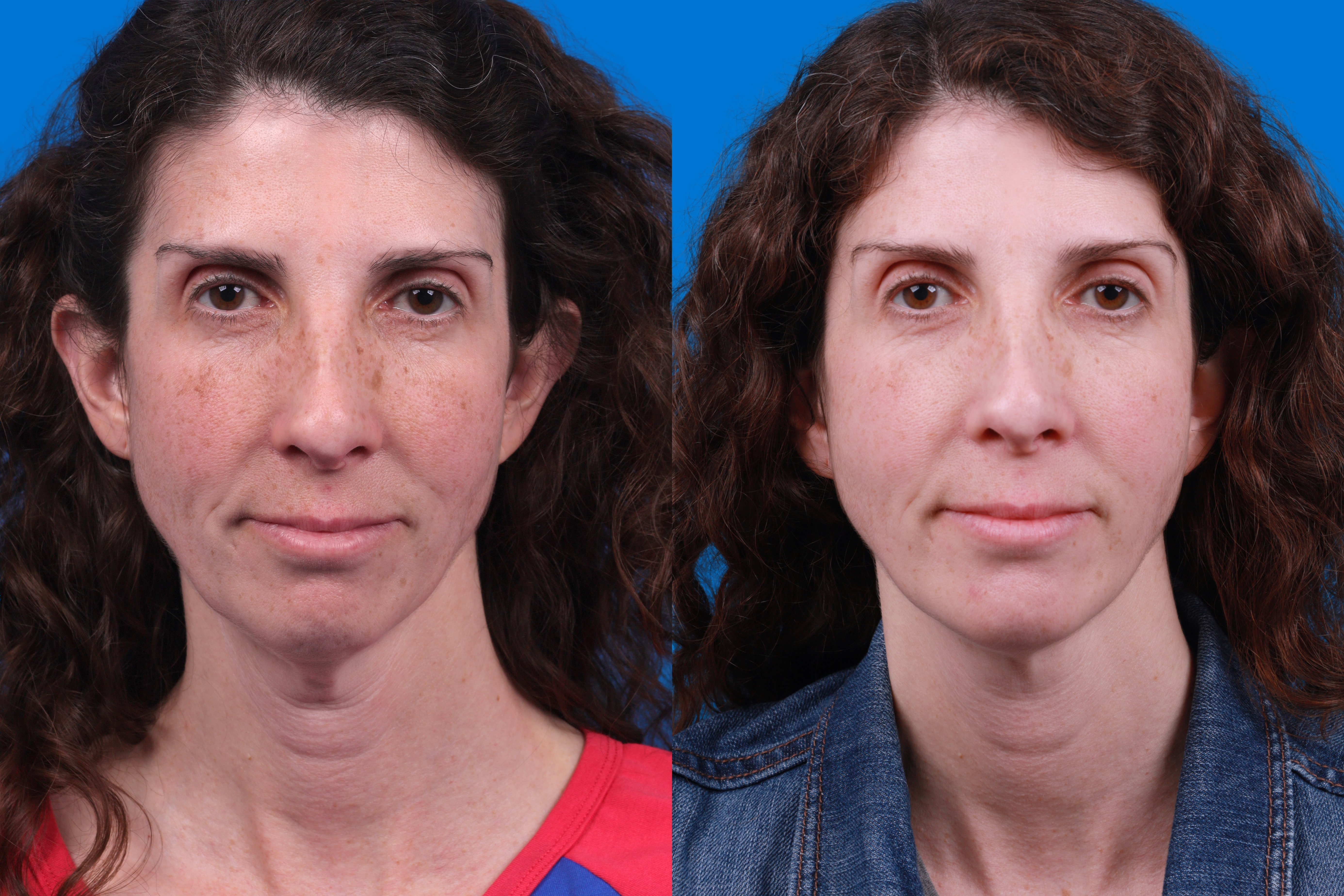 Morpheus8 Before & After Gallery - Patient 842745 - Image 1