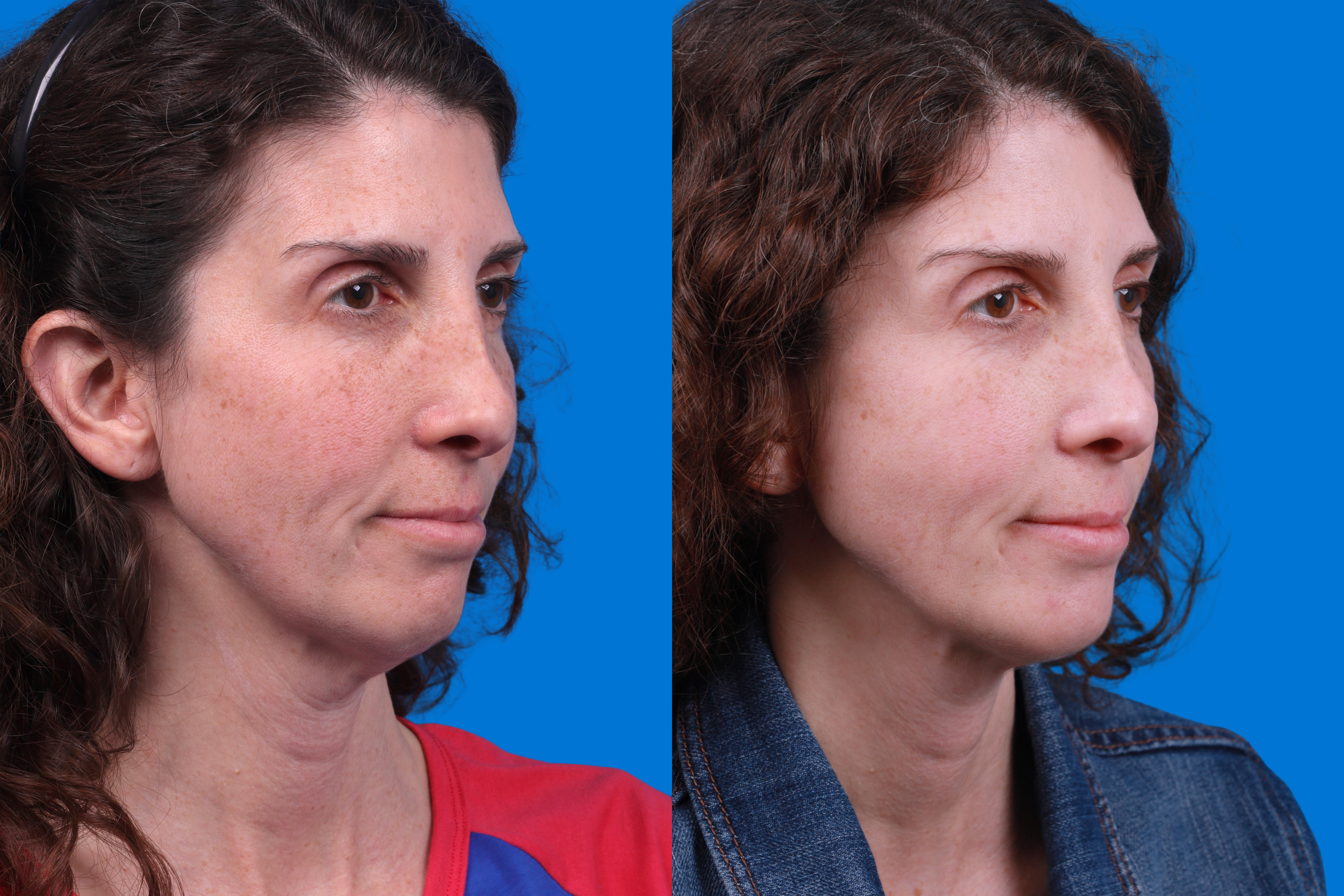 Morpheus8 Before & After Gallery - Patient 842745 - Image 2