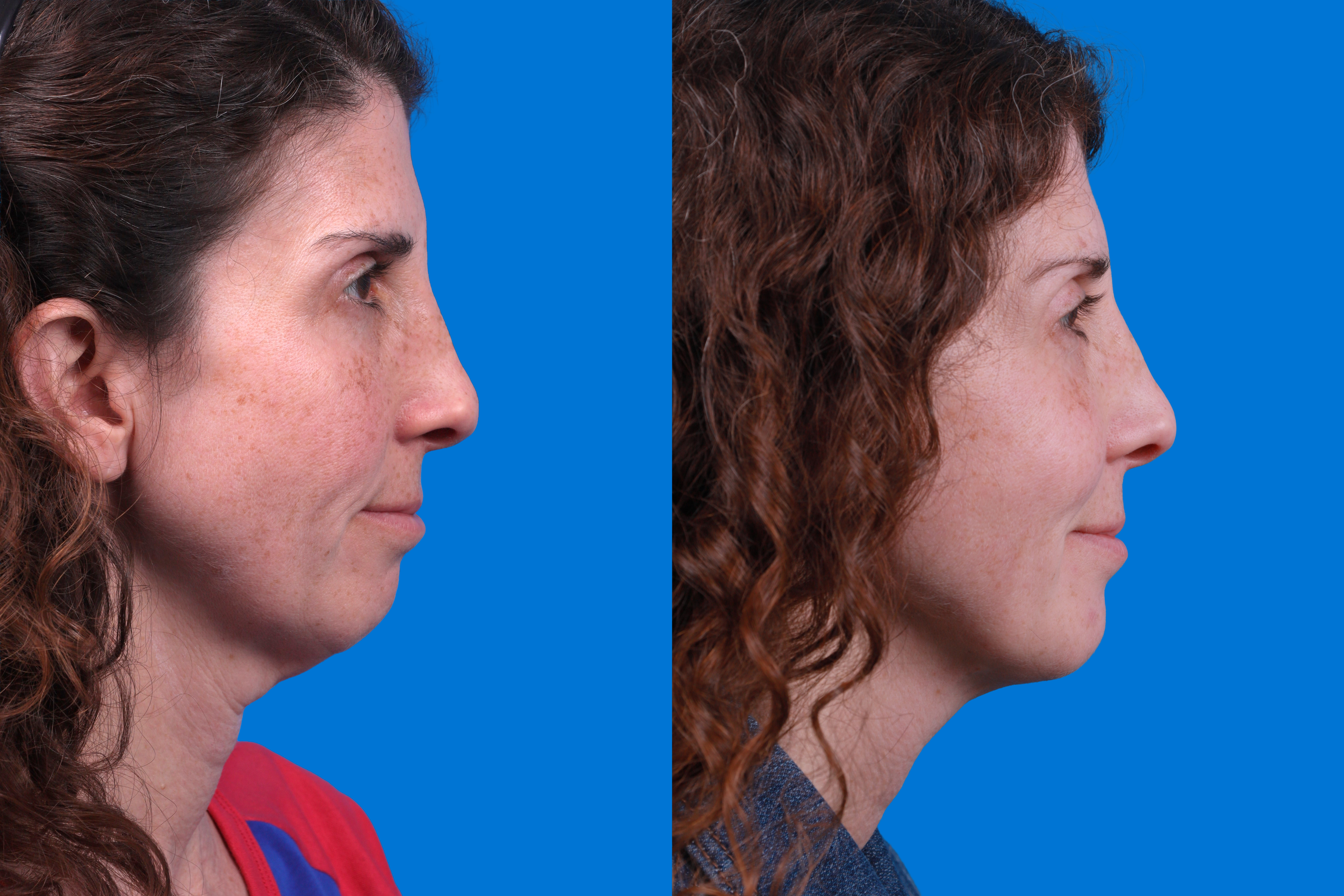 Morpheus8 Before & After Gallery - Patient 842745 - Image 3