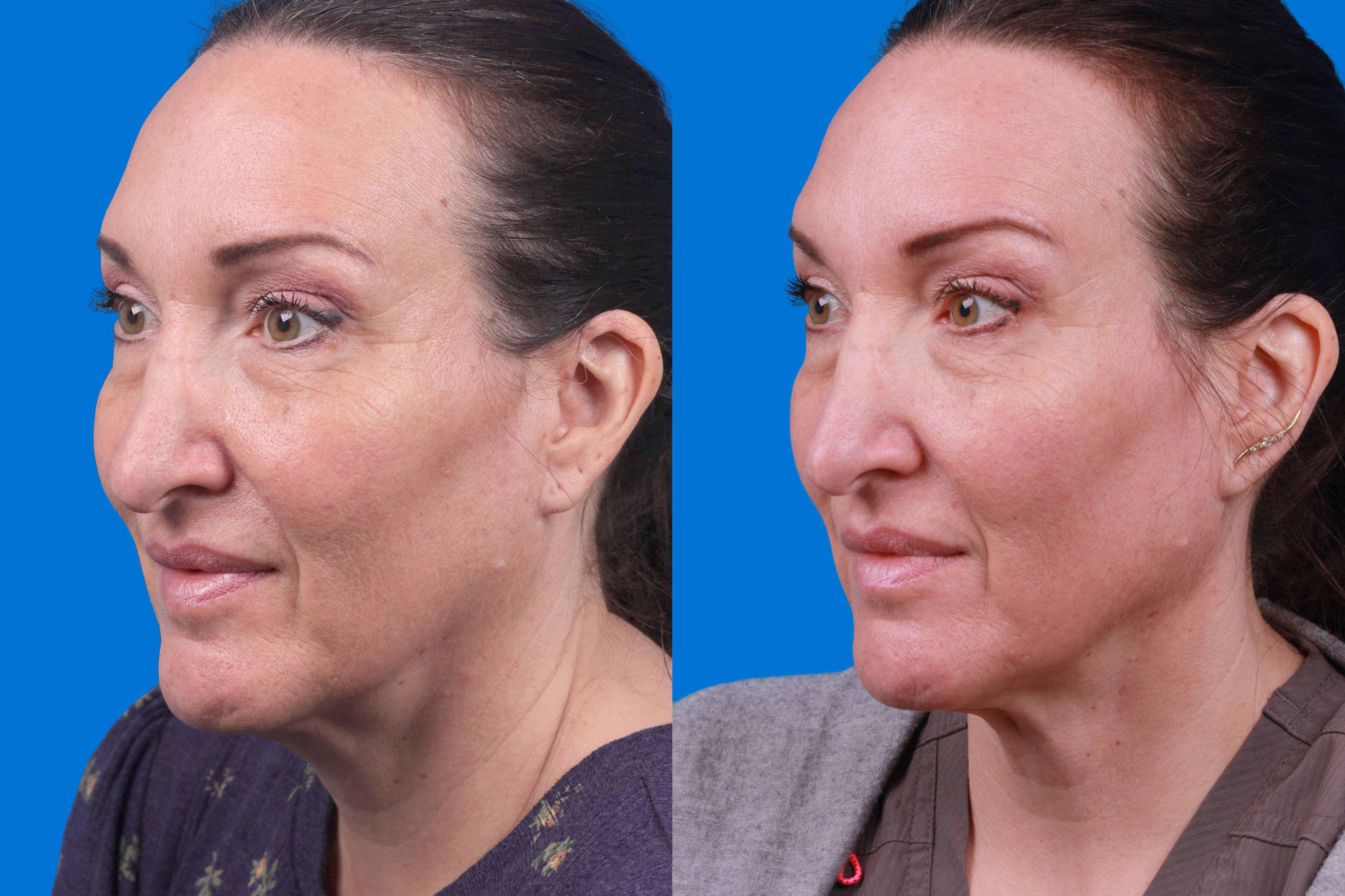 Morpheus8 Before & After Gallery - Patient 101722 - Image 5