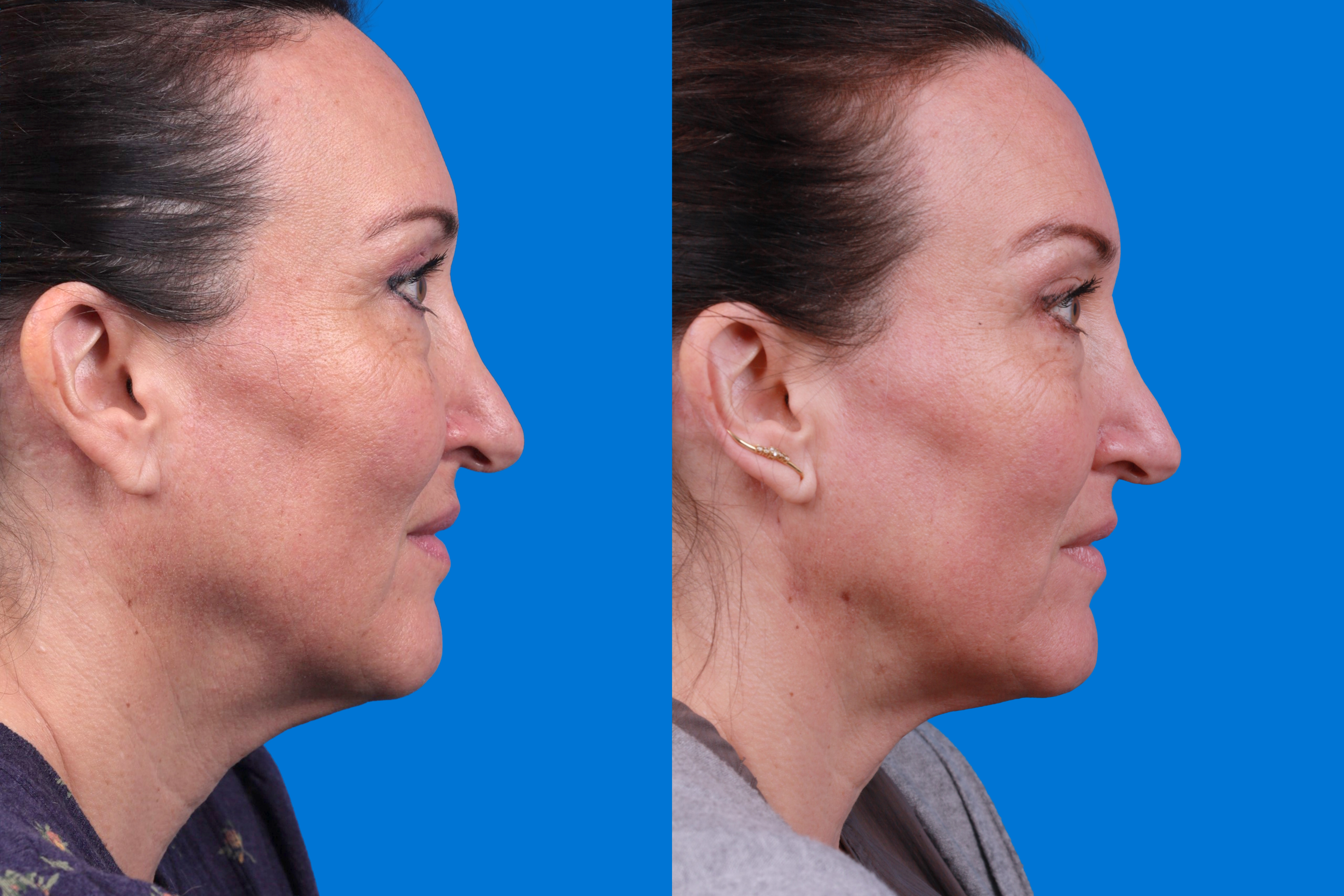 Morpheus8 Before & After Gallery - Patient 101722 - Image 3
