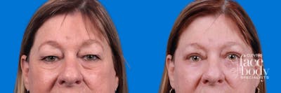 Eyelid Surgery Before & After Gallery - Patient 172334 - Image 1