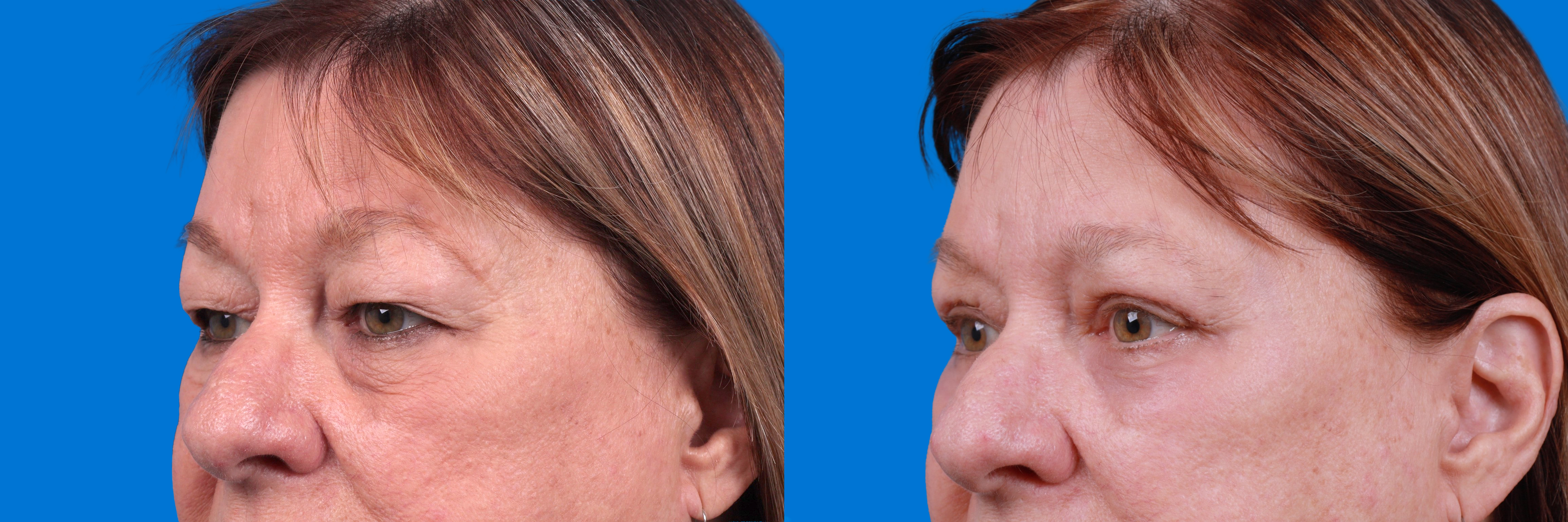 Eyelid Surgery Before & After Gallery - Patient 172334 - Image 3