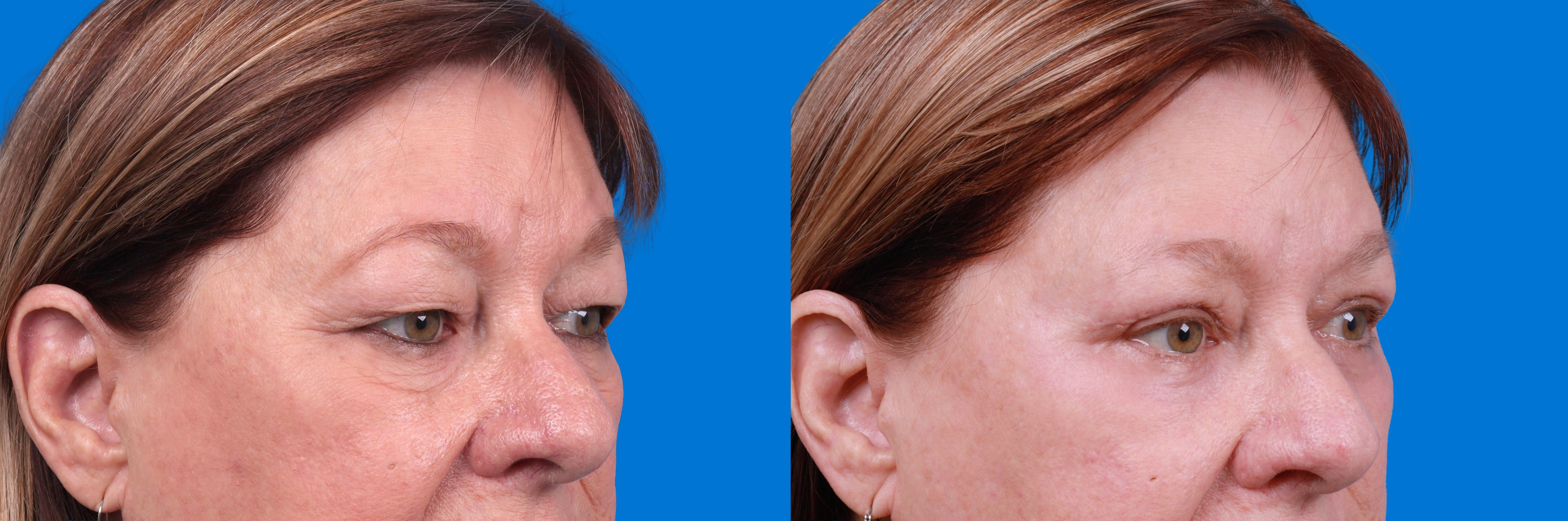Eyelid Surgery Before & After Gallery - Patient 172334 - Image 2