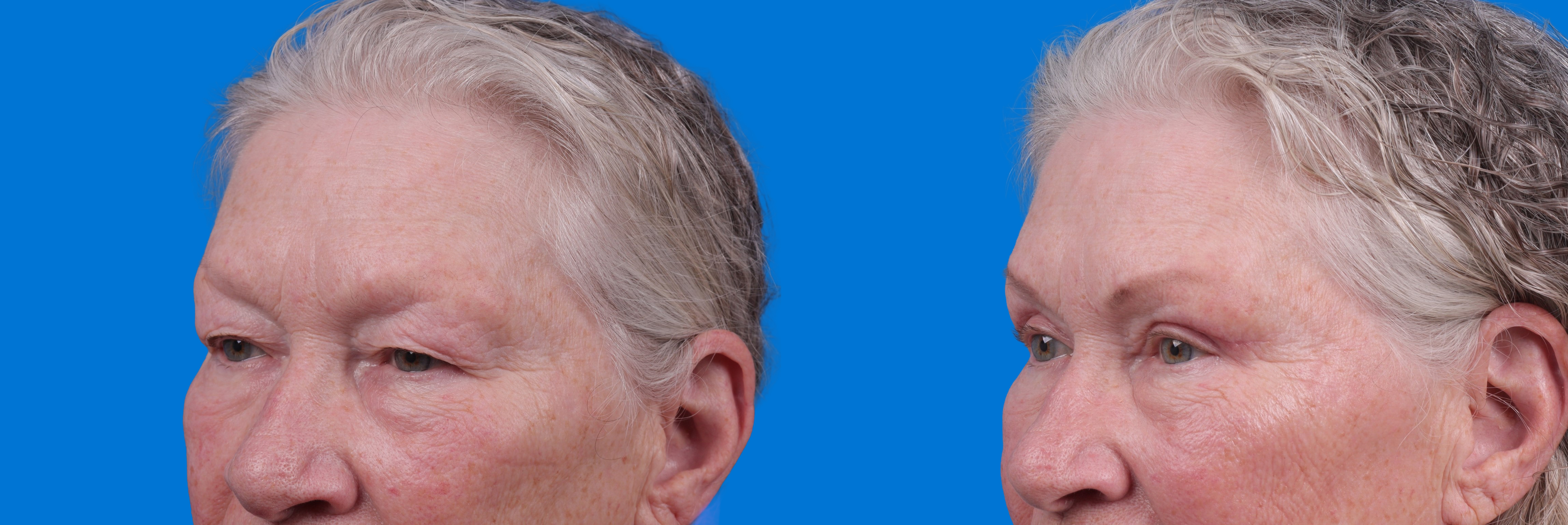 Eyelid Surgery Before & After Gallery - Patient 127648 - Image 2