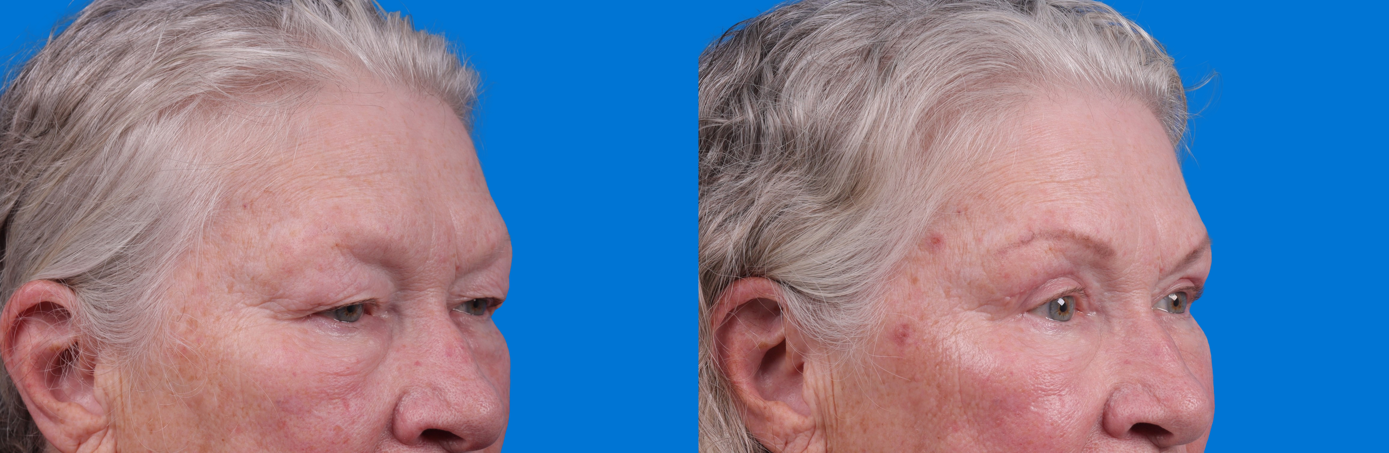 Eyelid Surgery Before & After Gallery - Patient 127648 - Image 3