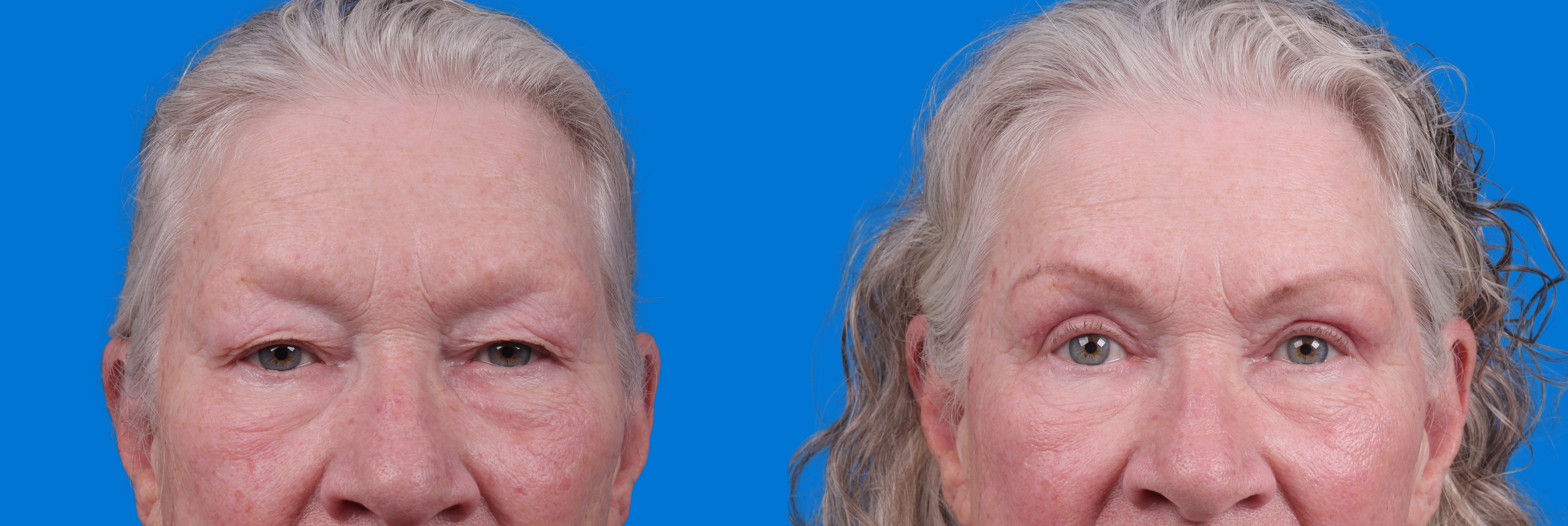 Eyelid Surgery Before & After Gallery - Patient 127648 - Image 1
