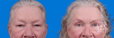 Eyelid Surgery Before & After Gallery - Patient 127648 - Image 1