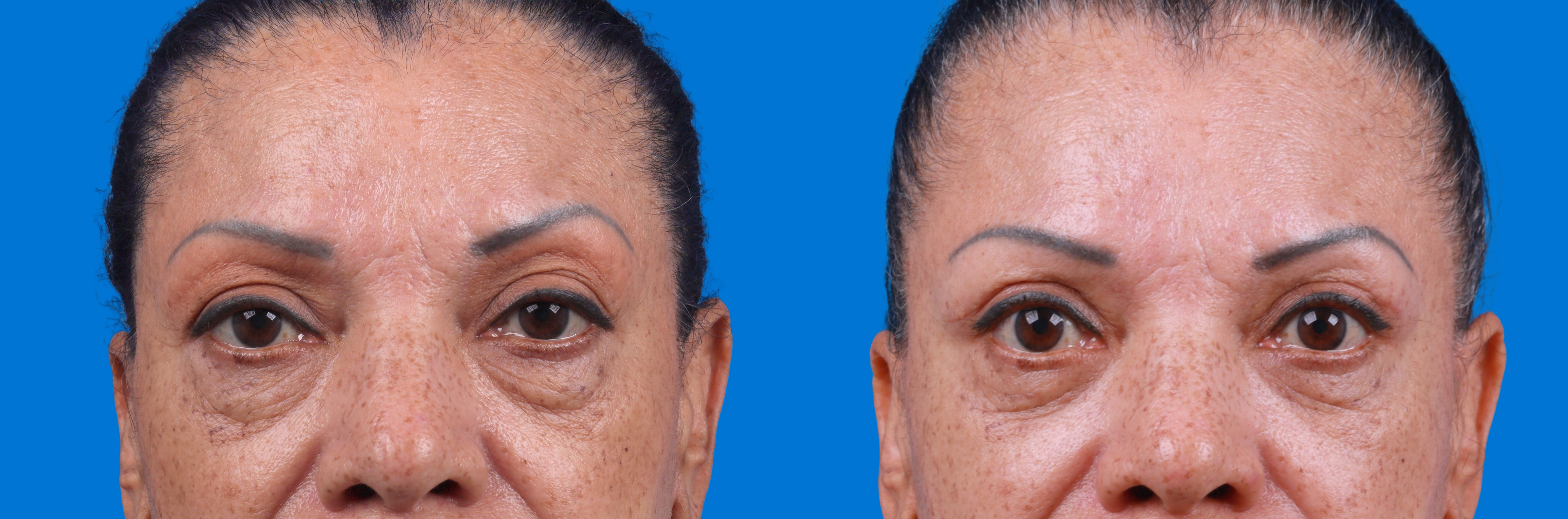 Eyelid Surgery Before & After Gallery - Patient 693055 - Image 1