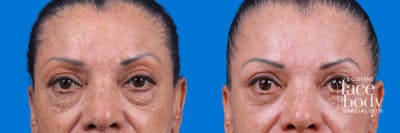 Eyelid Surgery Before & After Gallery - Patient 693055 - Image 1