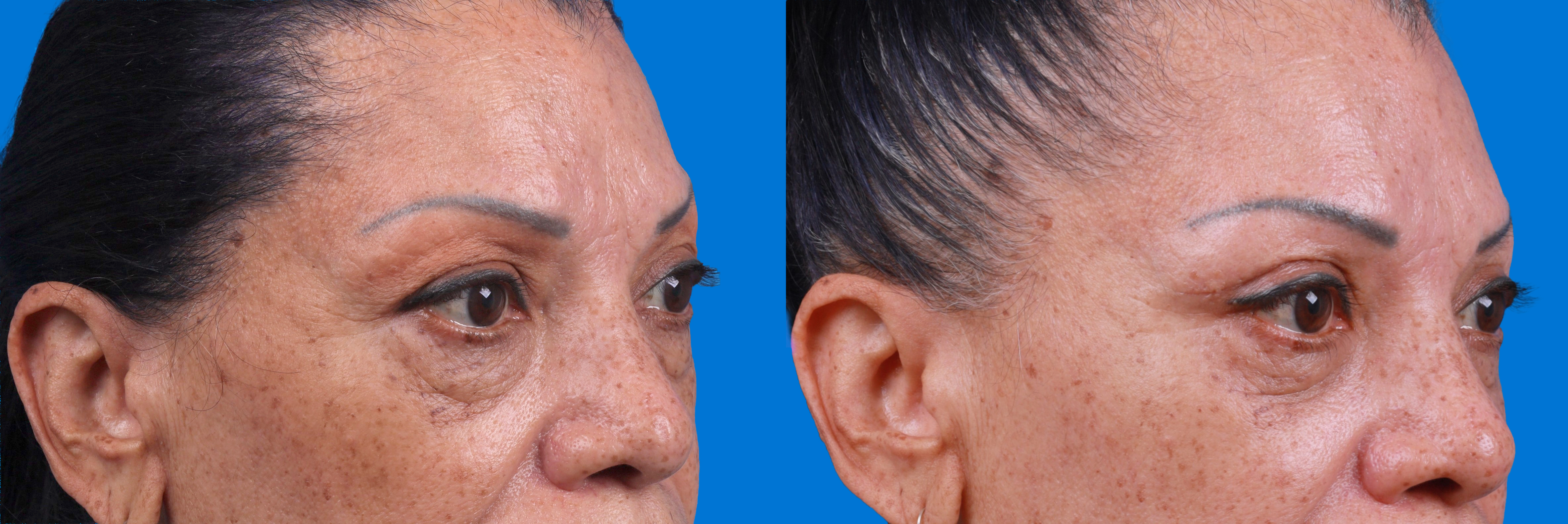 Eyelid Surgery Before & After Gallery - Patient 693055 - Image 3
