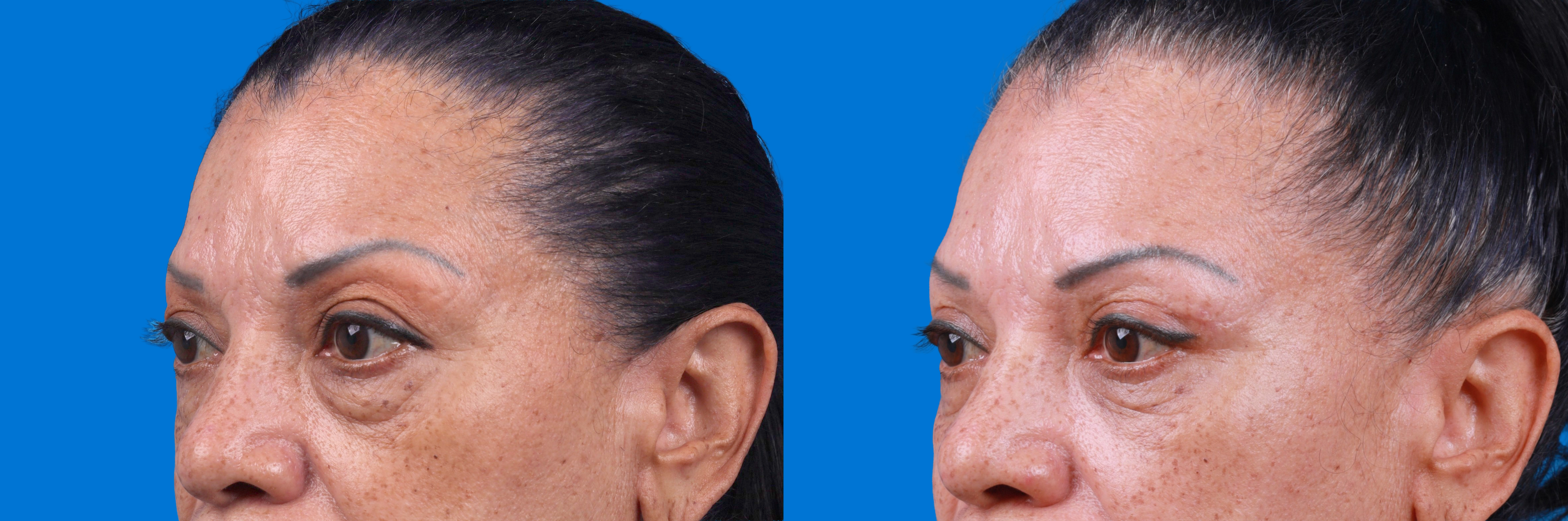 Eyelid Surgery Before & After Gallery - Patient 693055 - Image 2