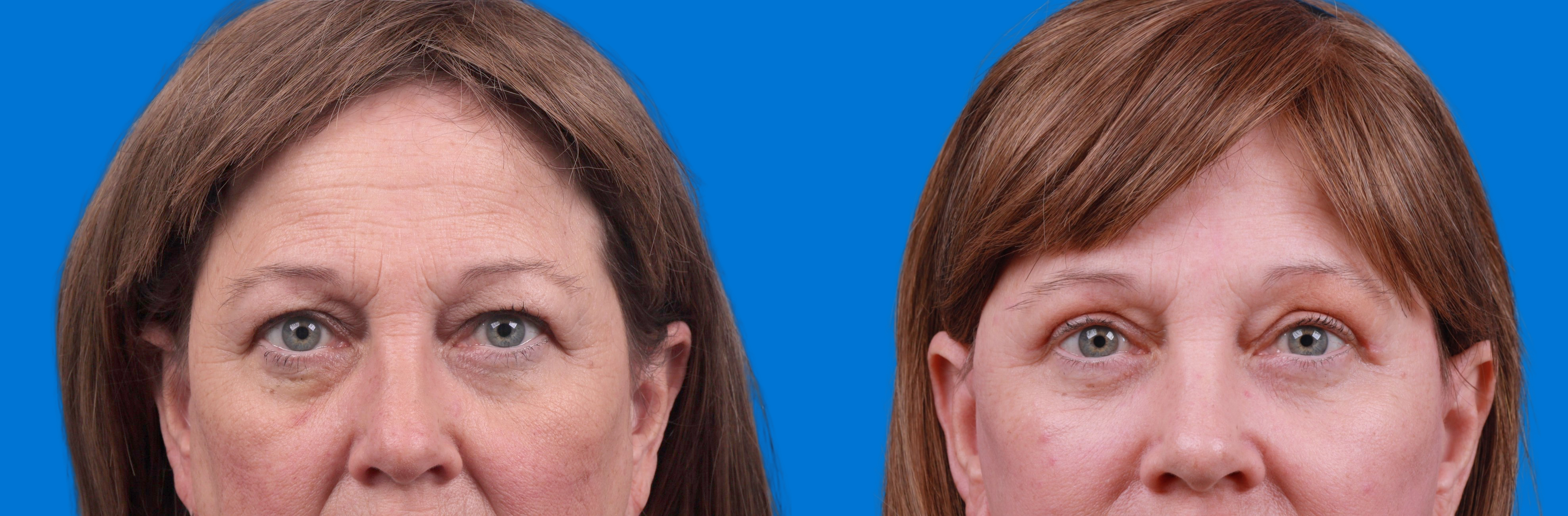 Eyelid Surgery Before & After Gallery - Patient 127787 - Image 1