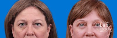Eyelid Surgery Before & After Gallery - Patient 127787 - Image 1