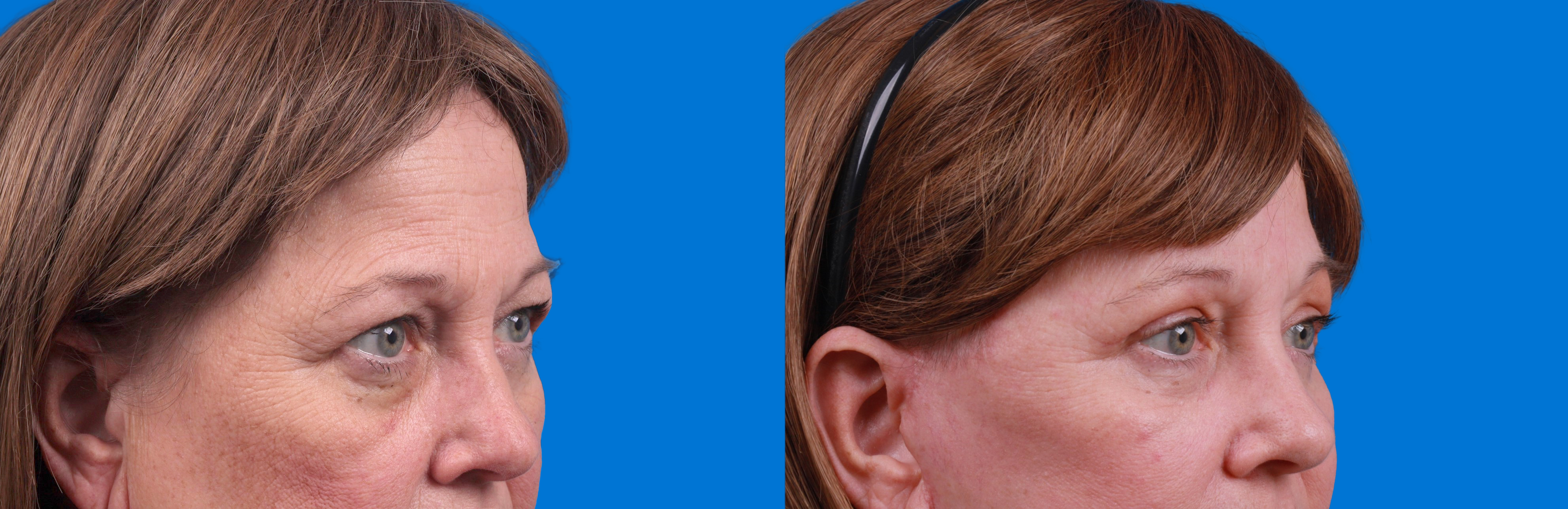 Eyelid Surgery Before & After Gallery - Patient 127787 - Image 2