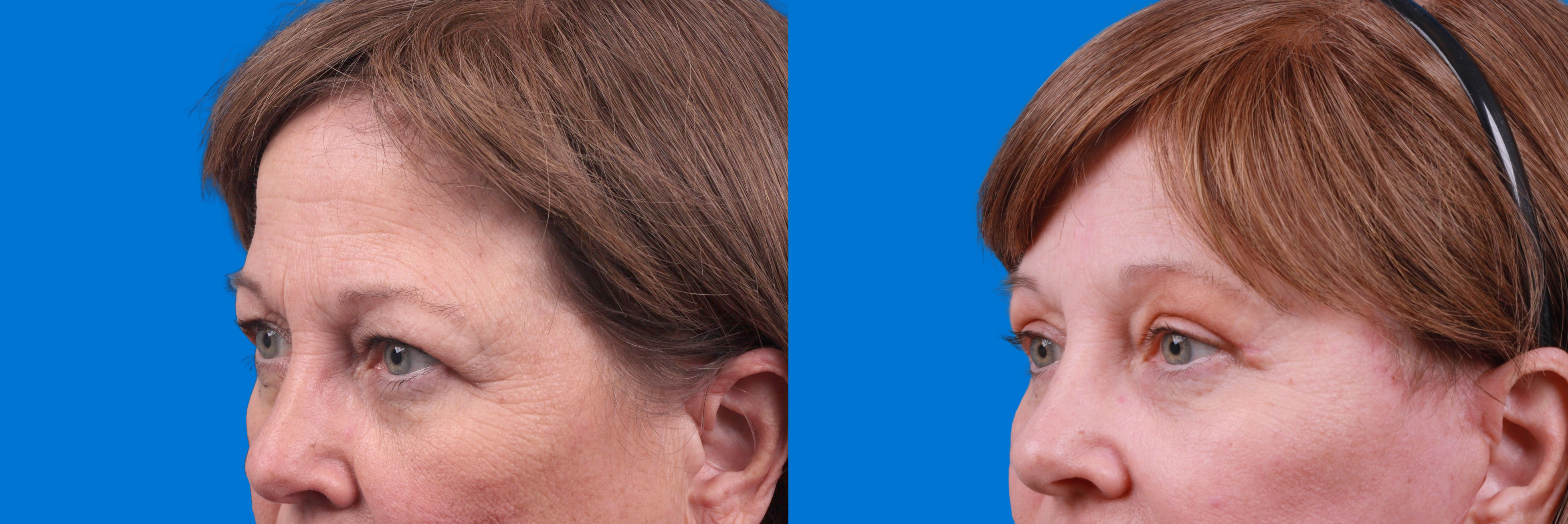 Eyelid Surgery Before & After Gallery - Patient 127787 - Image 3