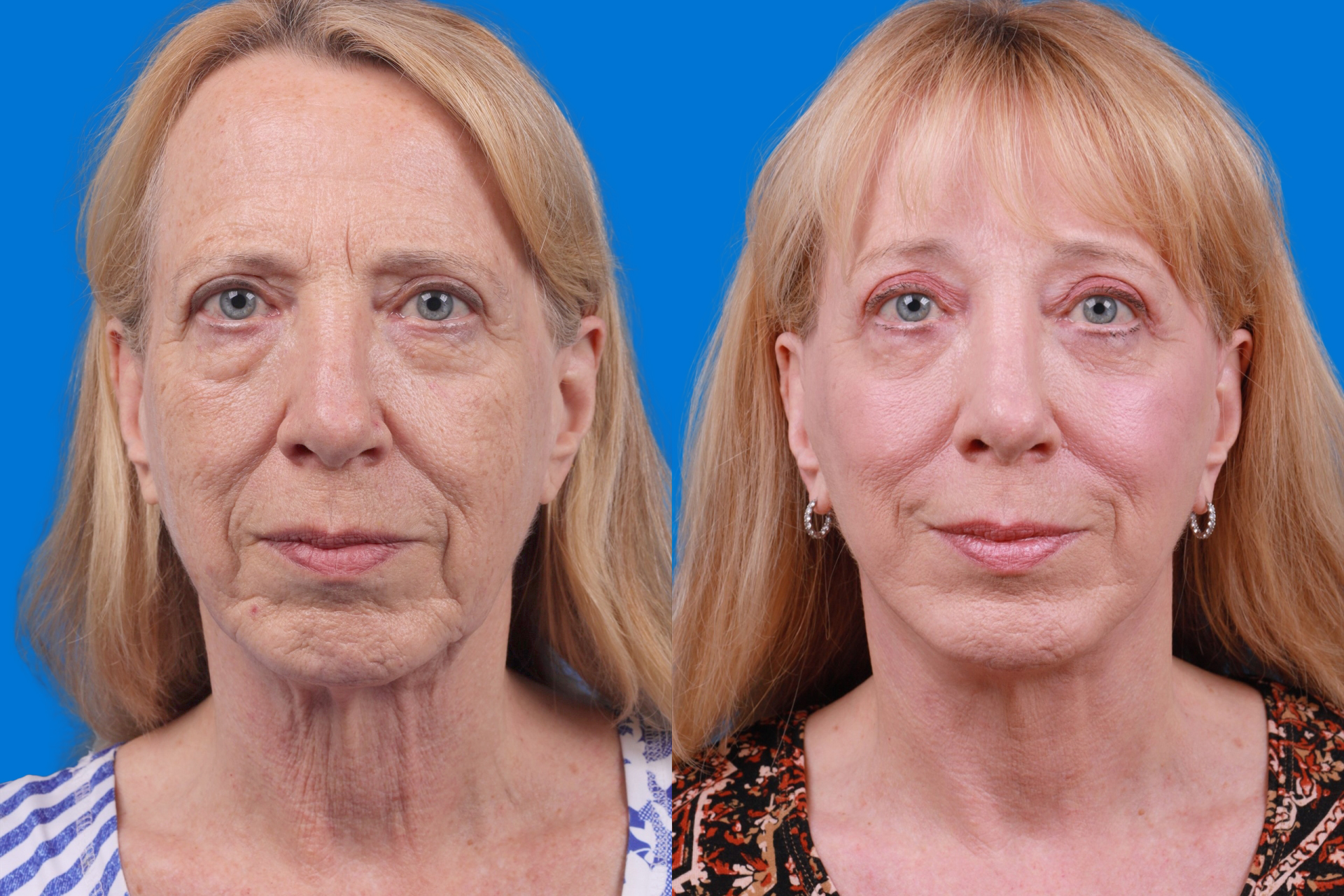 Eyelid Surgery Before & After Gallery - Patient 386386 - Image 1