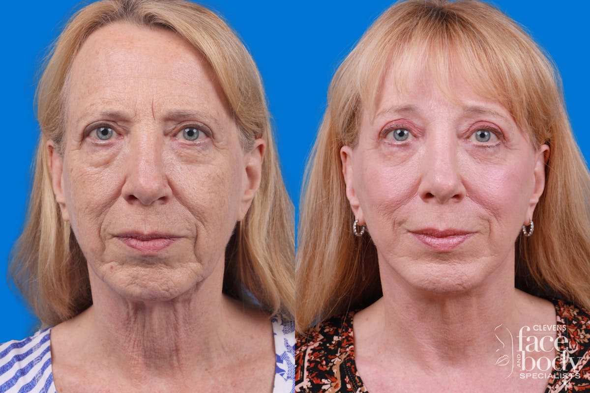 Facelift Before & After Gallery - Patient 122593604 - Image 3