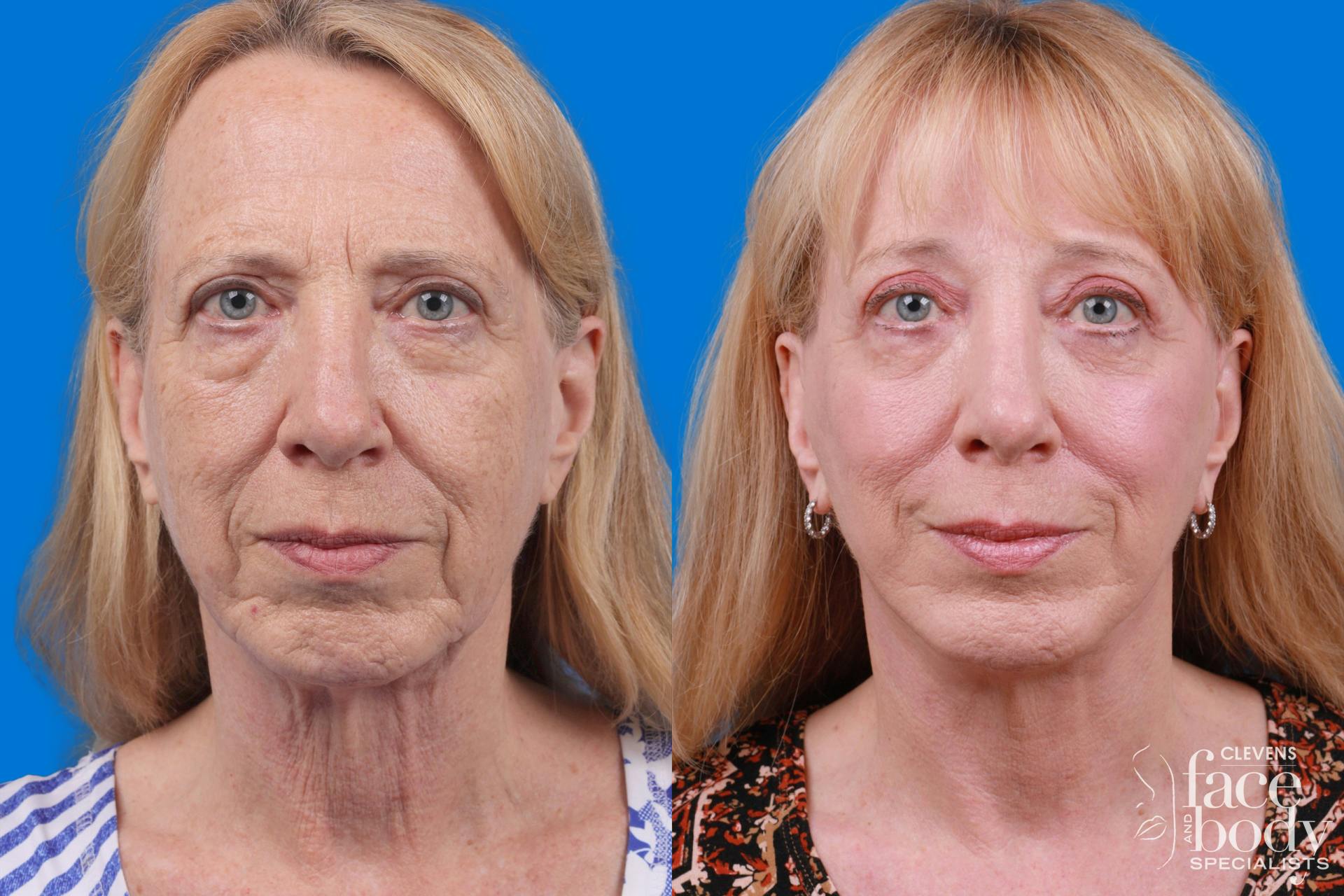 Facelift Before & After Gallery - Patient 122593604 - Image 3