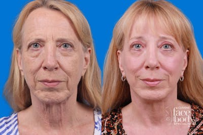 Eyelid Surgery Before & After Gallery - Patient 386386 - Image 1